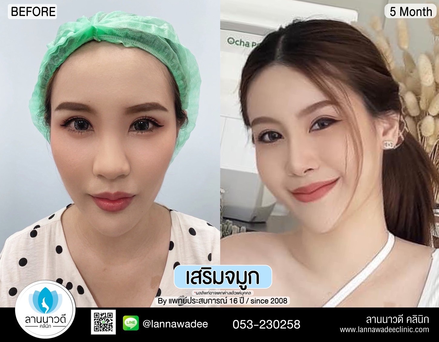 รีวิวเสริมจมูกเชียงใหม่