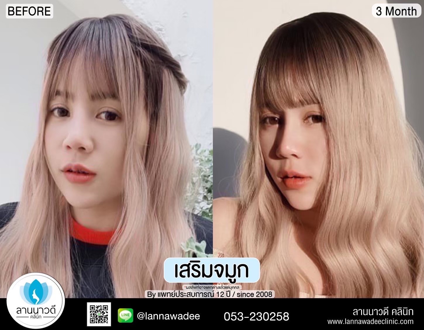 รีวิวเสริมจมูกเชียงใหม่