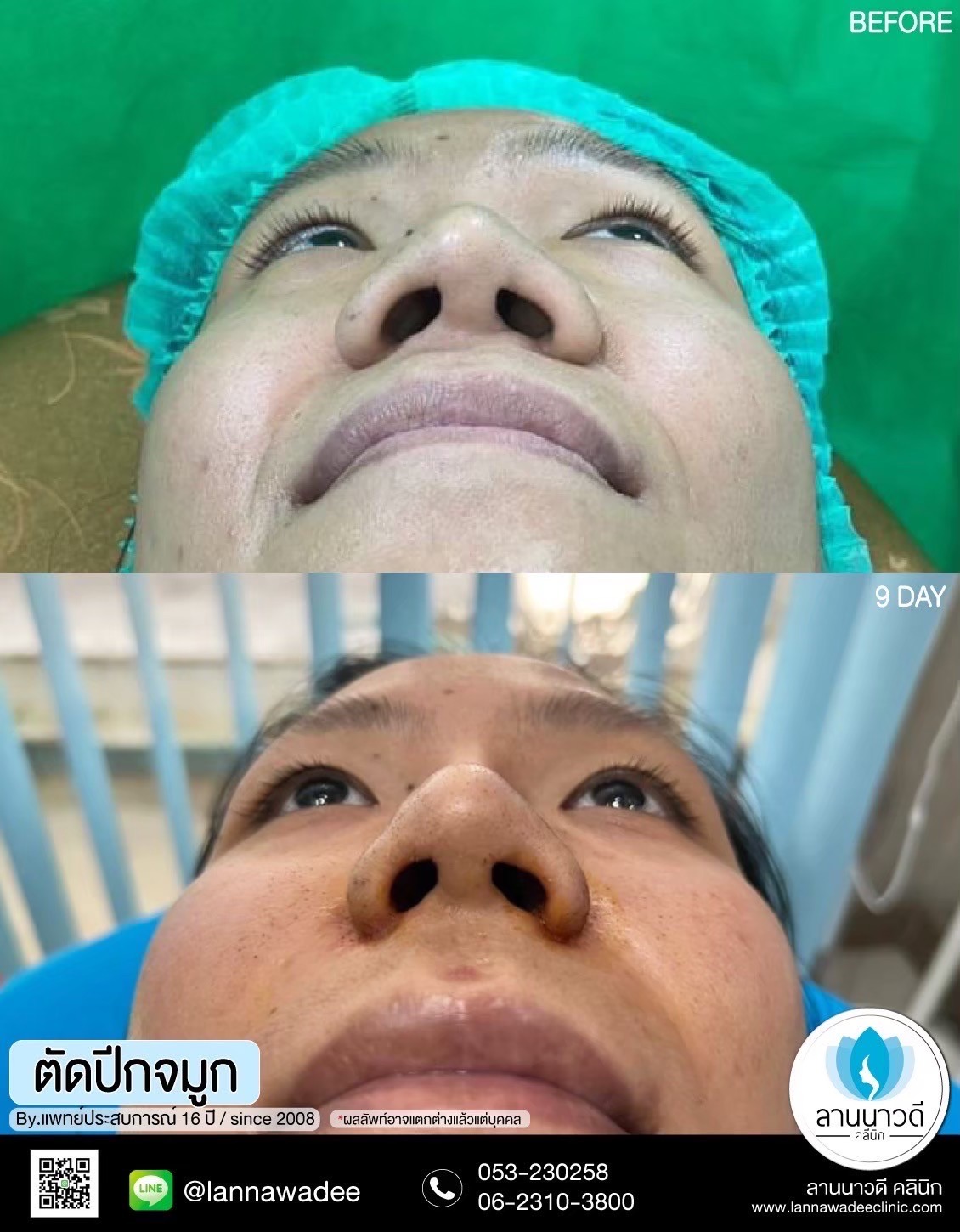 ตัดปีกจมูกเชียงใหม่