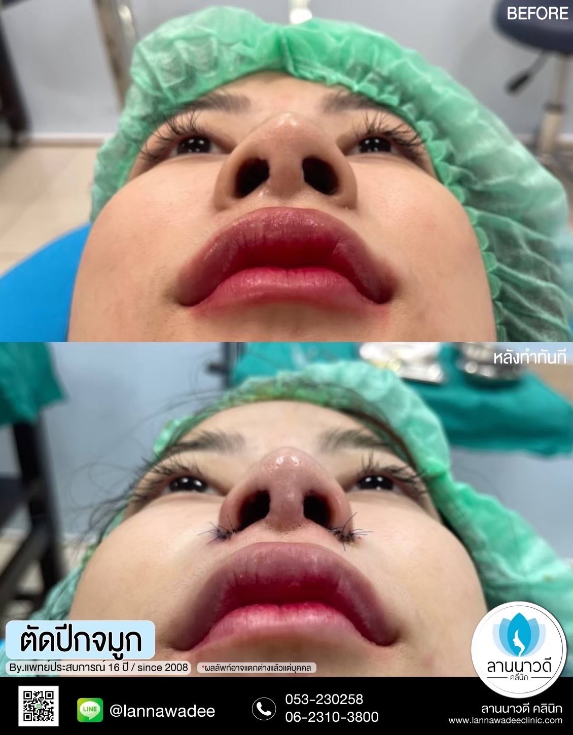 ตัดปีกจมูก