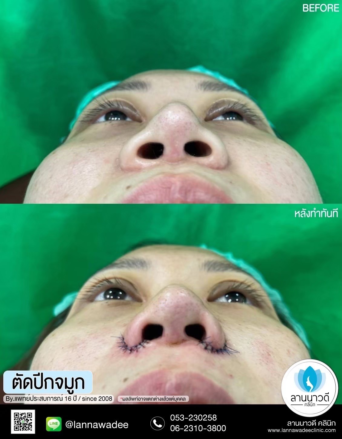 ตัดปีกจมูกเชียงใหม่