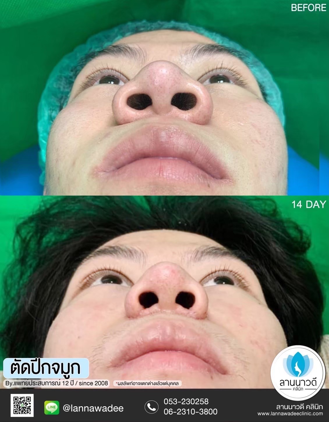 ตัดปีกจมูกเชียงใหม่