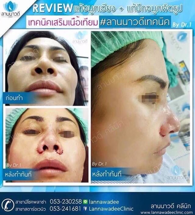 ตัดปีกจมูกเชียงใหม่