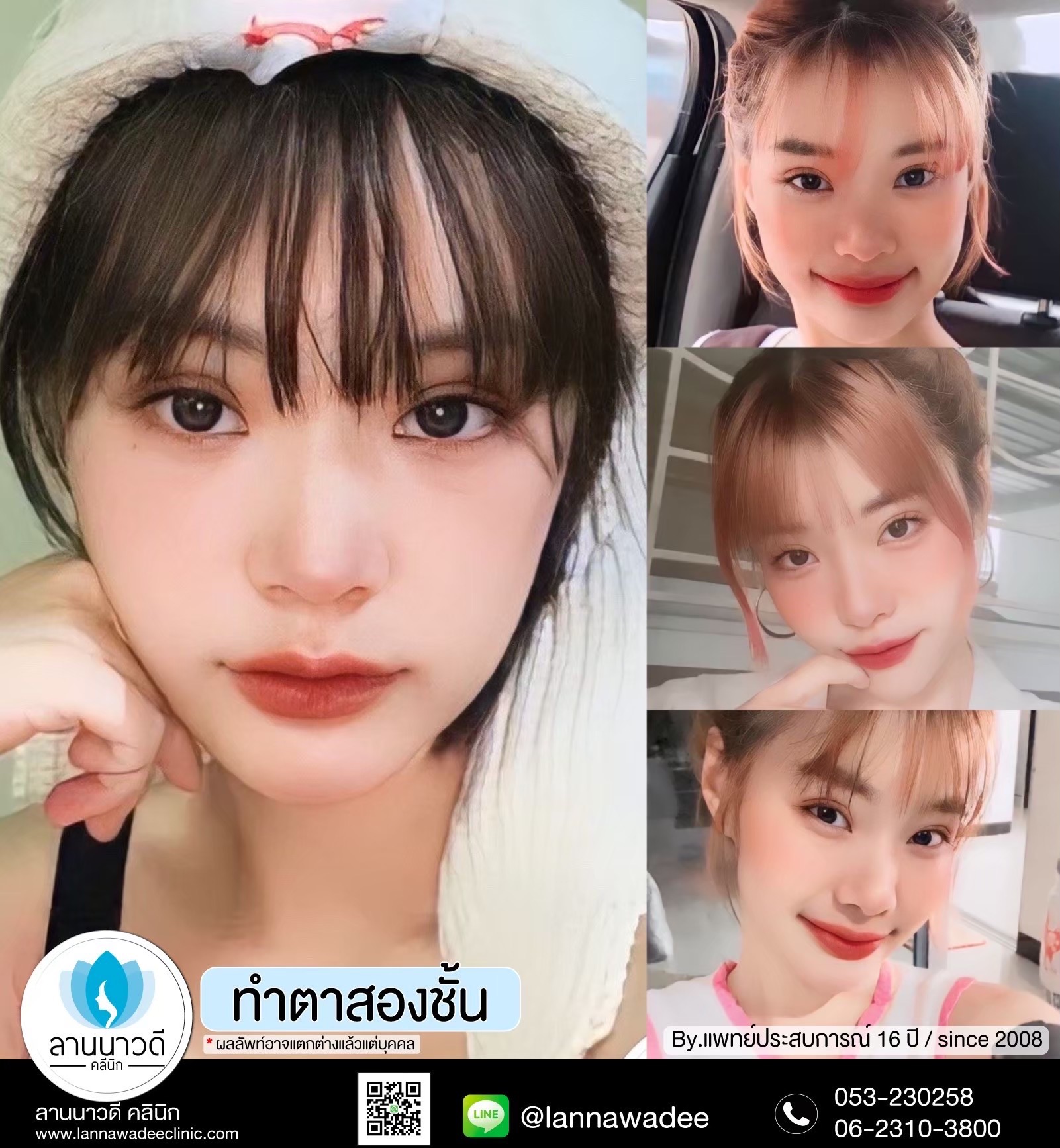 Double Eyelid Surgery Chiang Mai