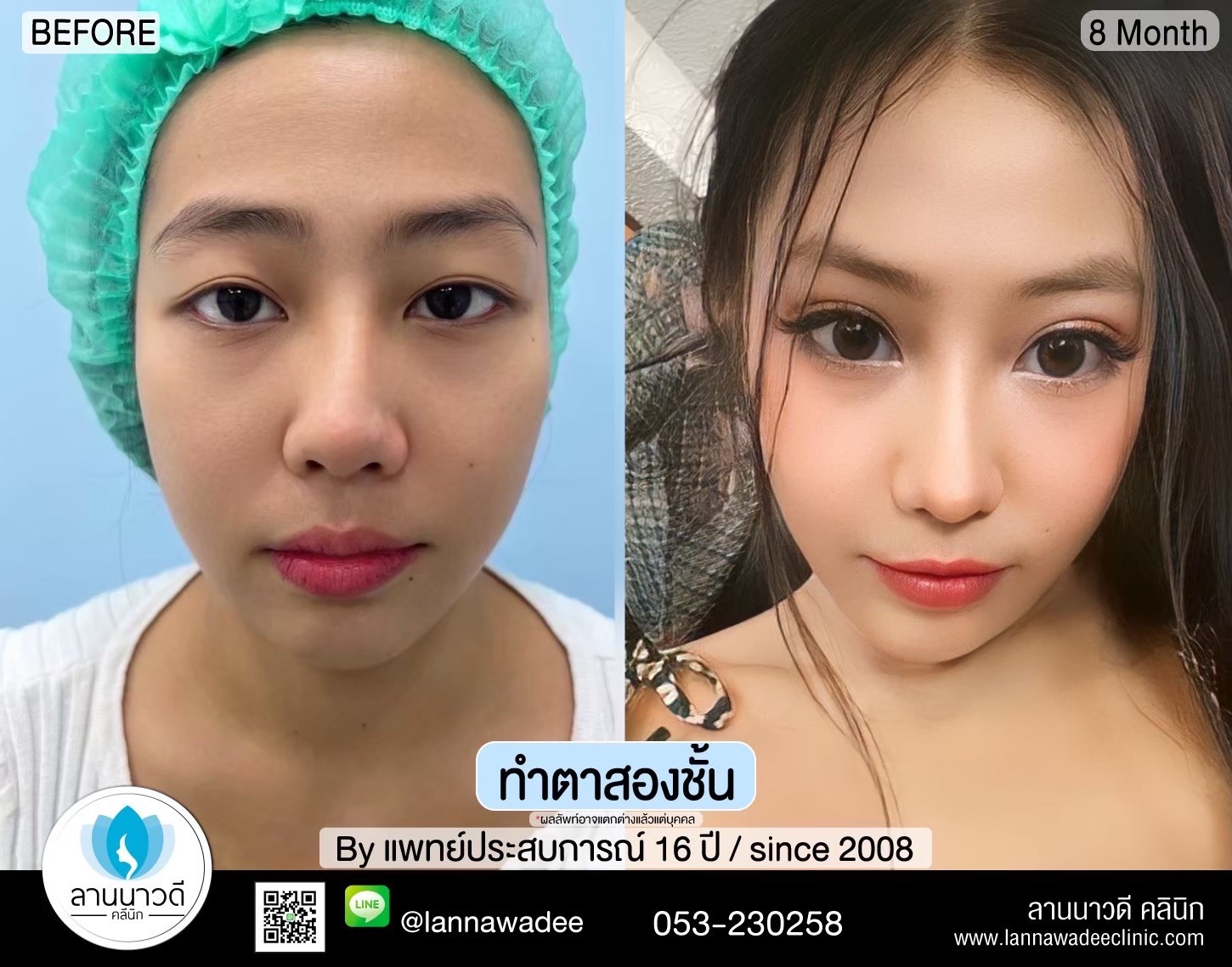 Double Eyelid Surgery Chiang Mai