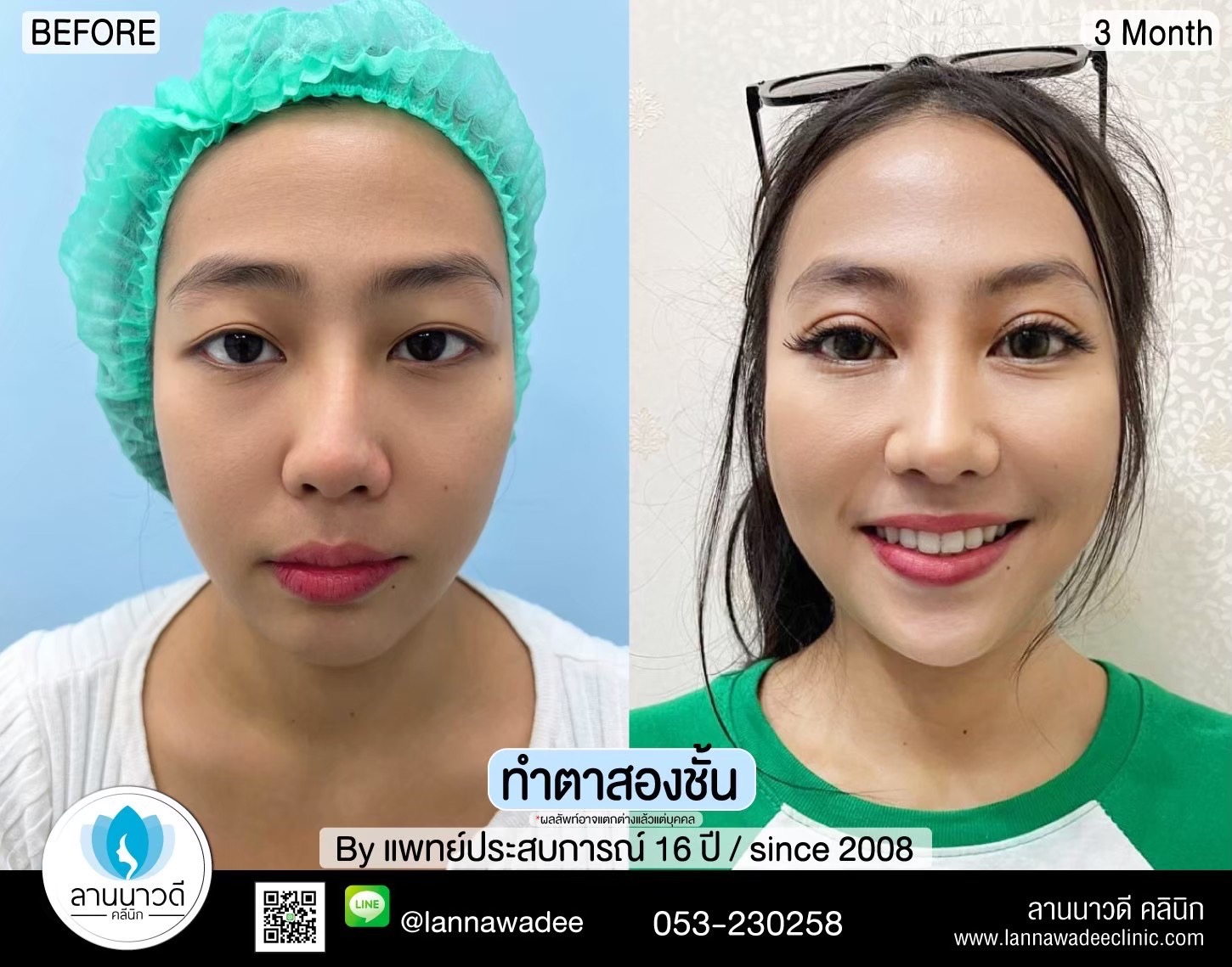 Double Eyelid Surgery Chiang Mai