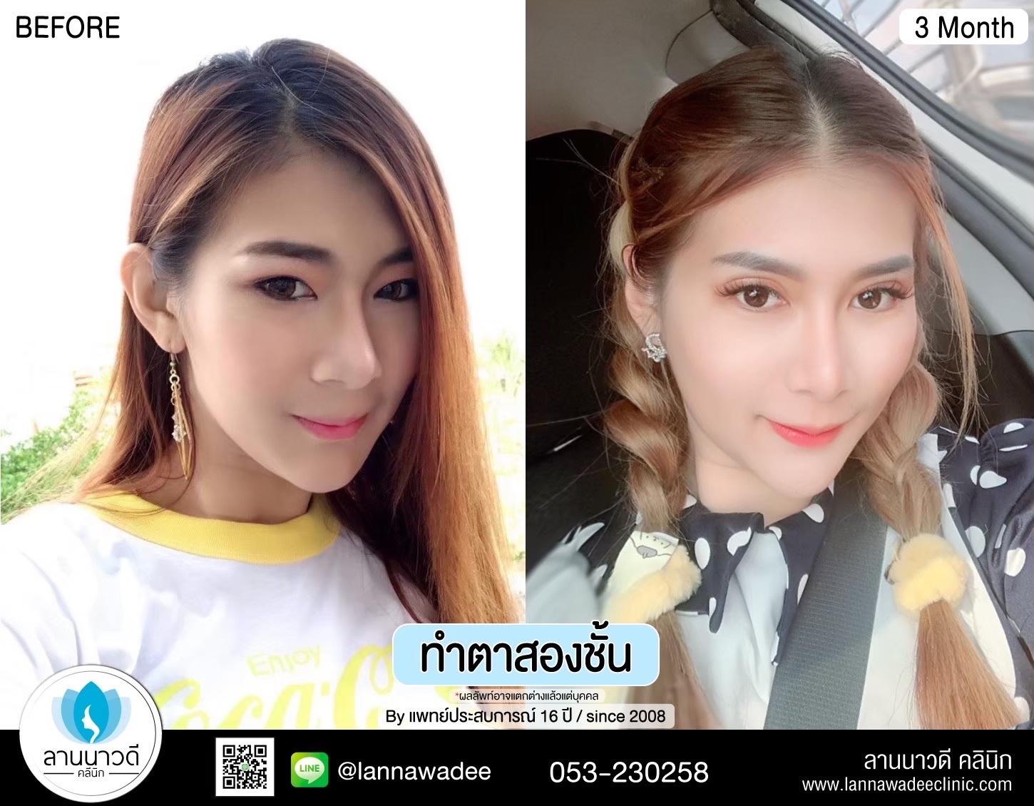 Double Eyelid Surgery Chiang Mai