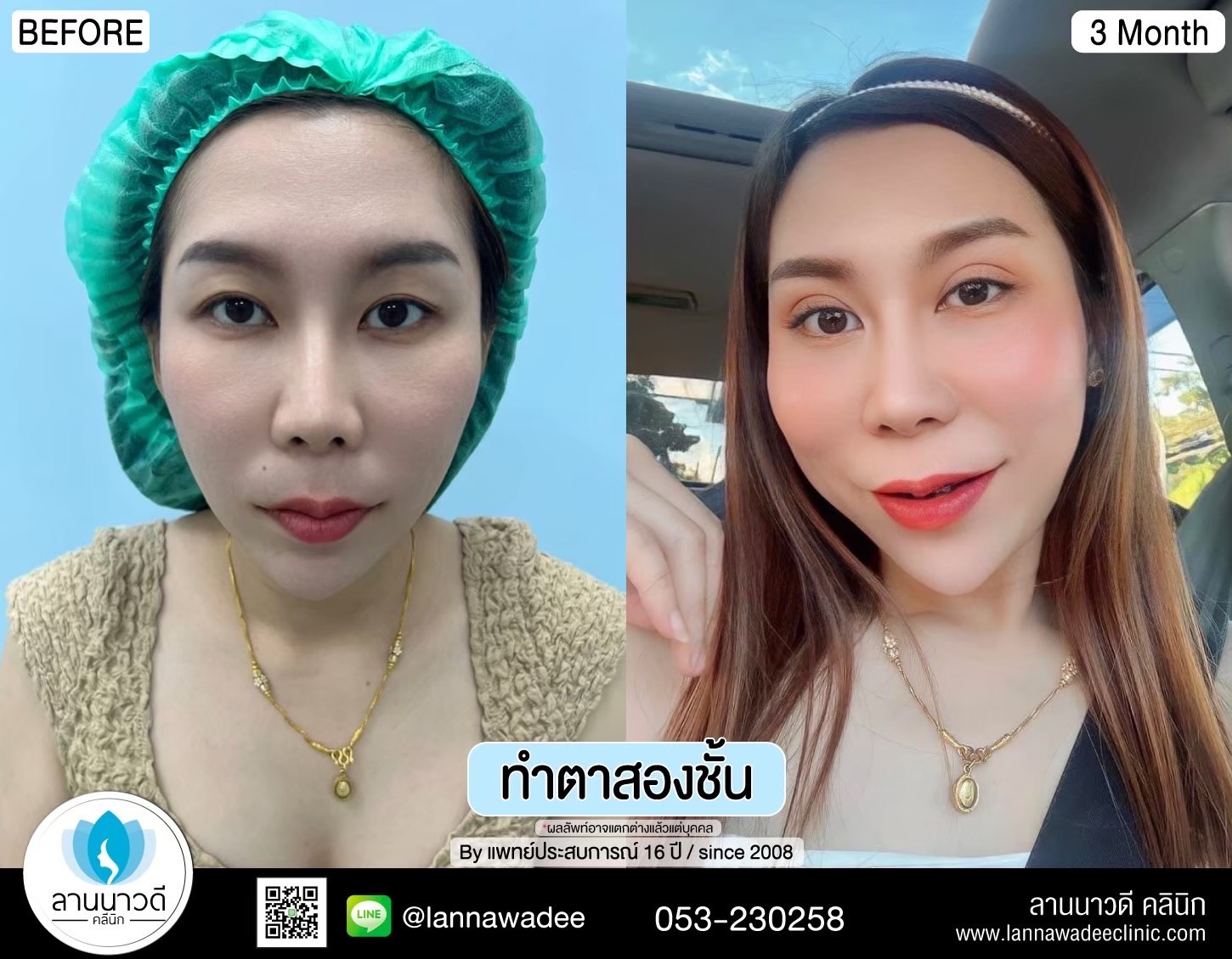 Double Eyelid Surgery Chiang Mai