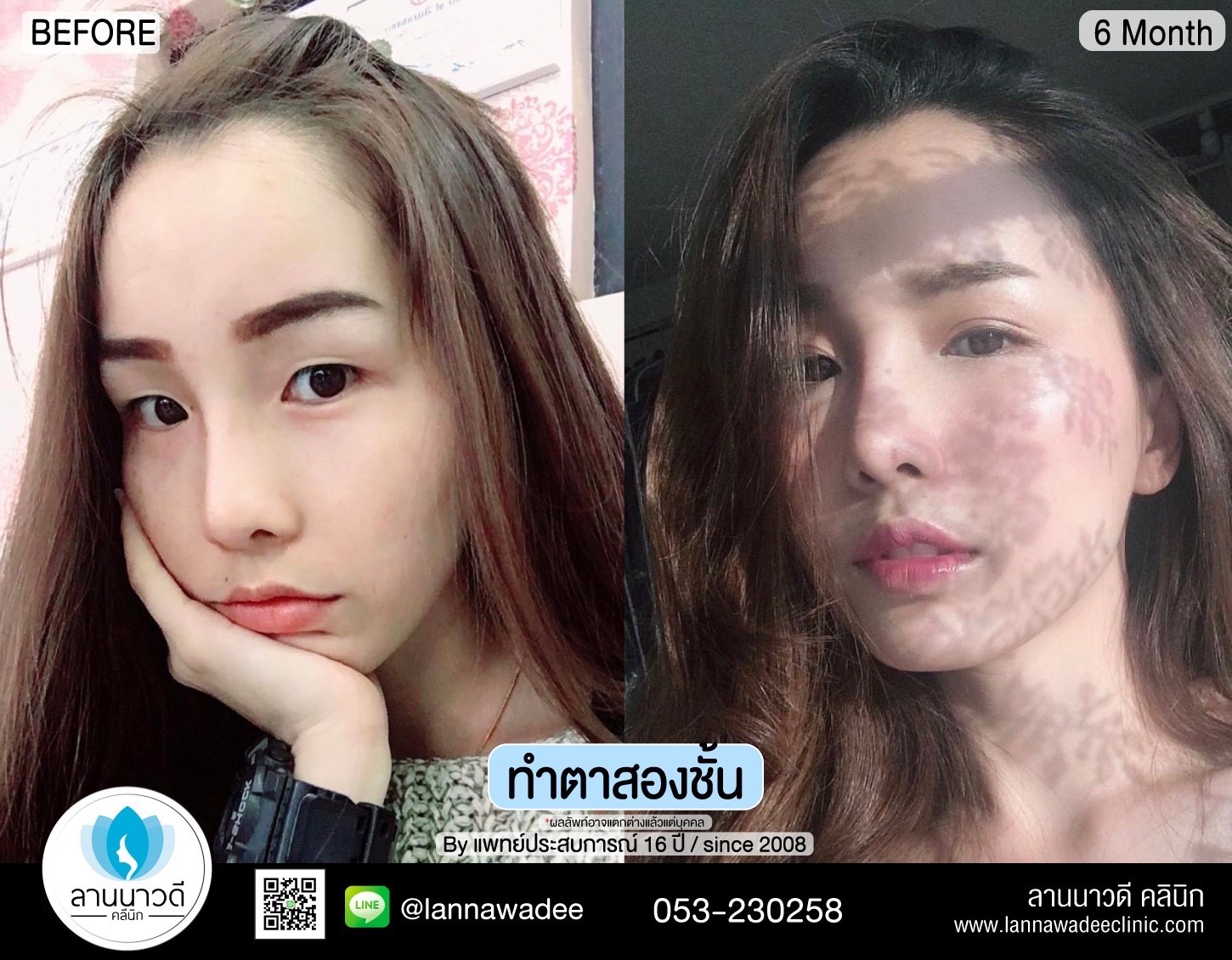 Double Eyelid Surgery Chiang Mai