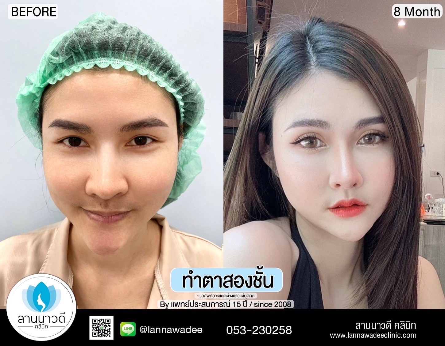 Double Eyelid Surgery Chiang Mai