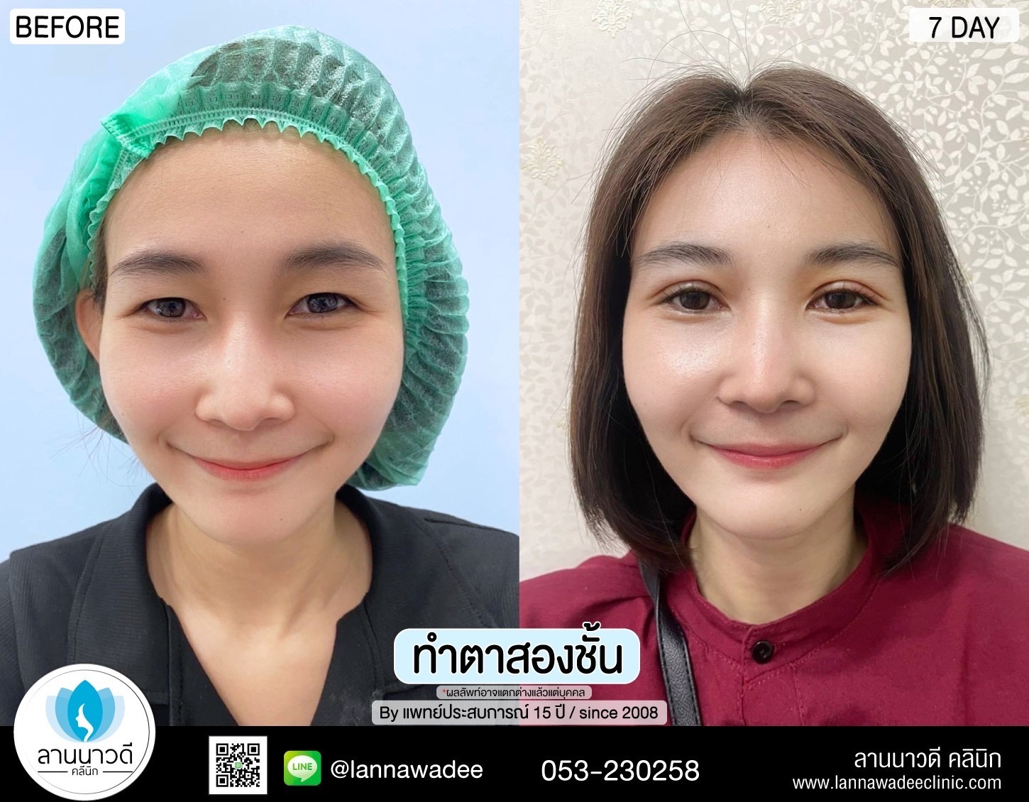 Double Eyelid Surgery Chiang Mai