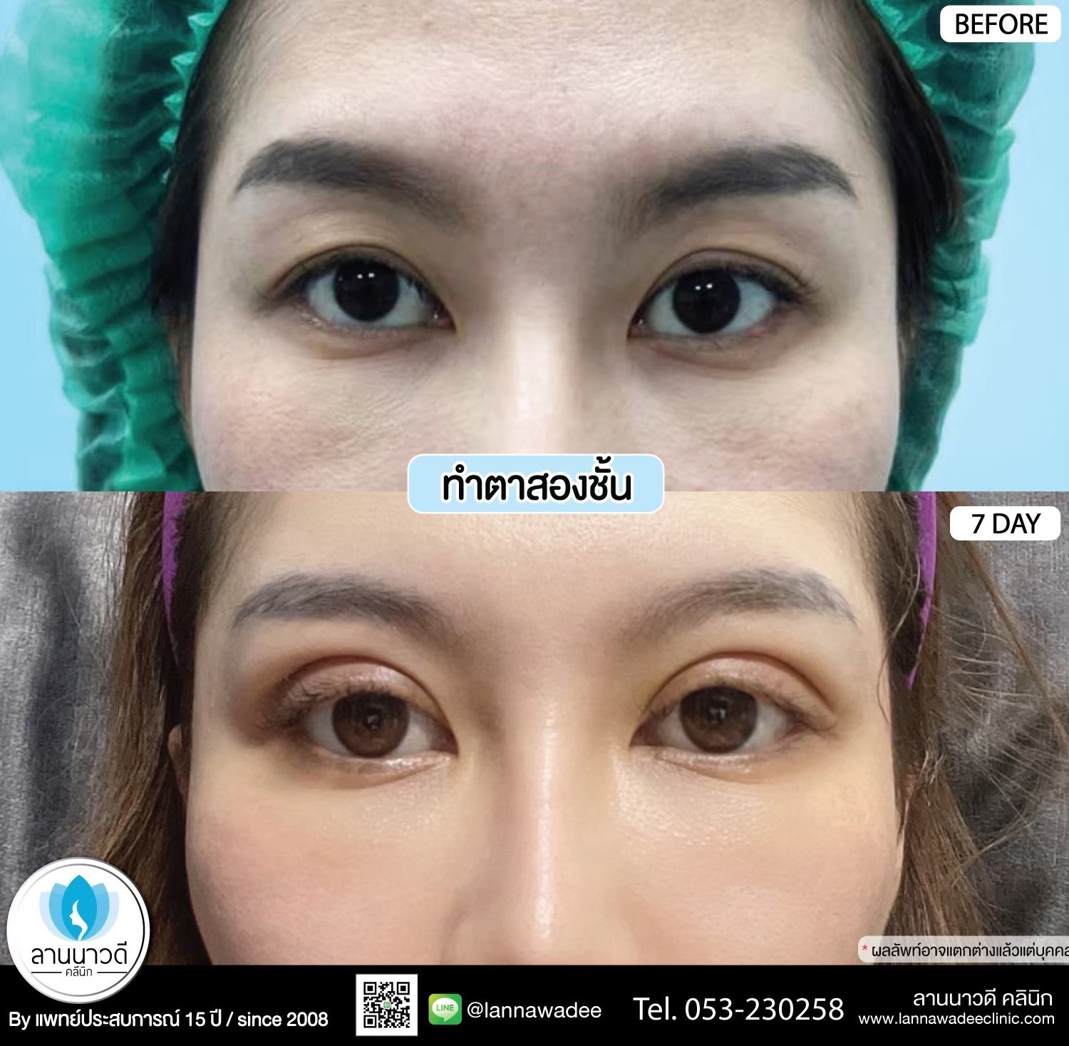 Double Eyelid Surgery Chiang Mai