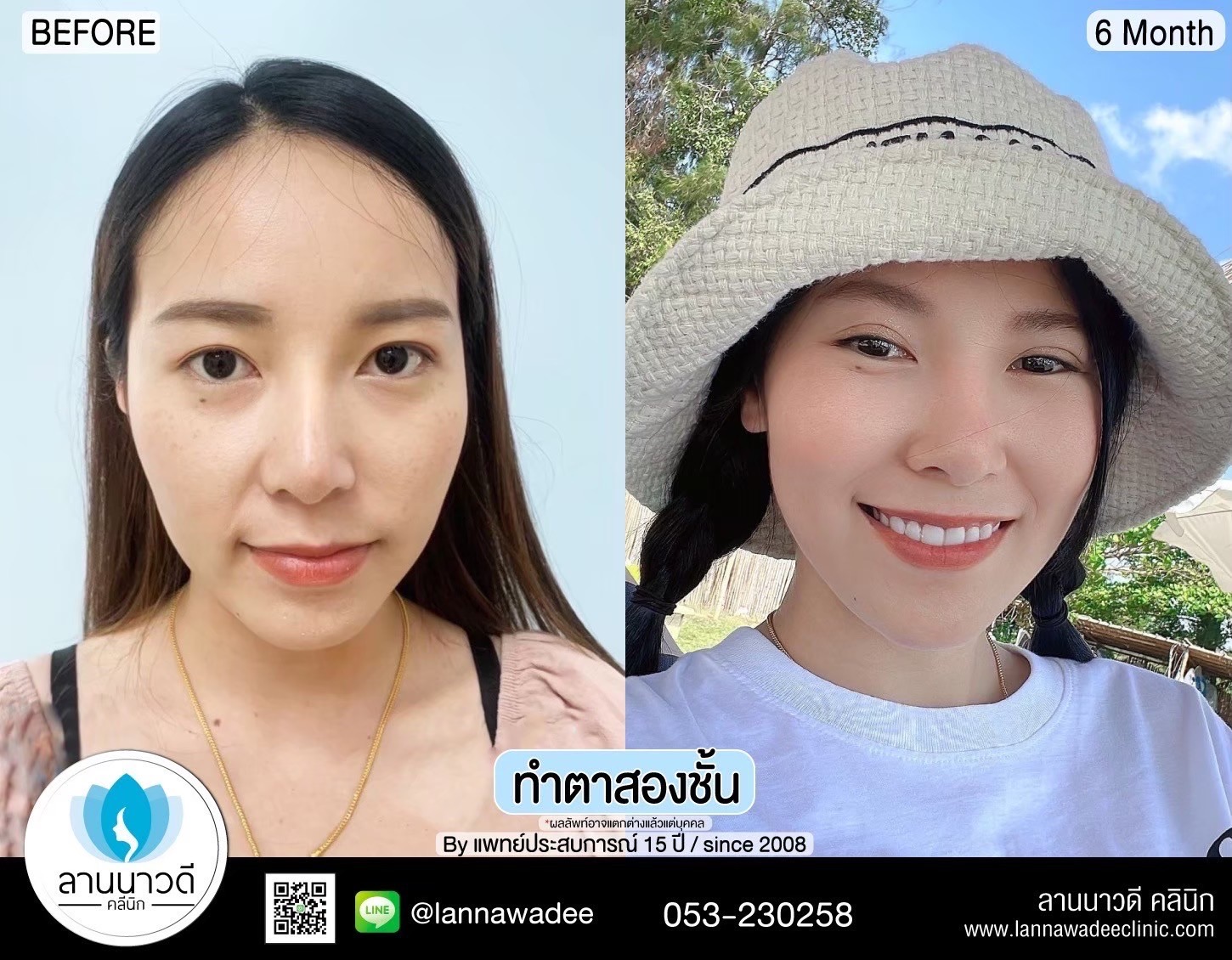 Double Eyelid Surgery Chiang Mai