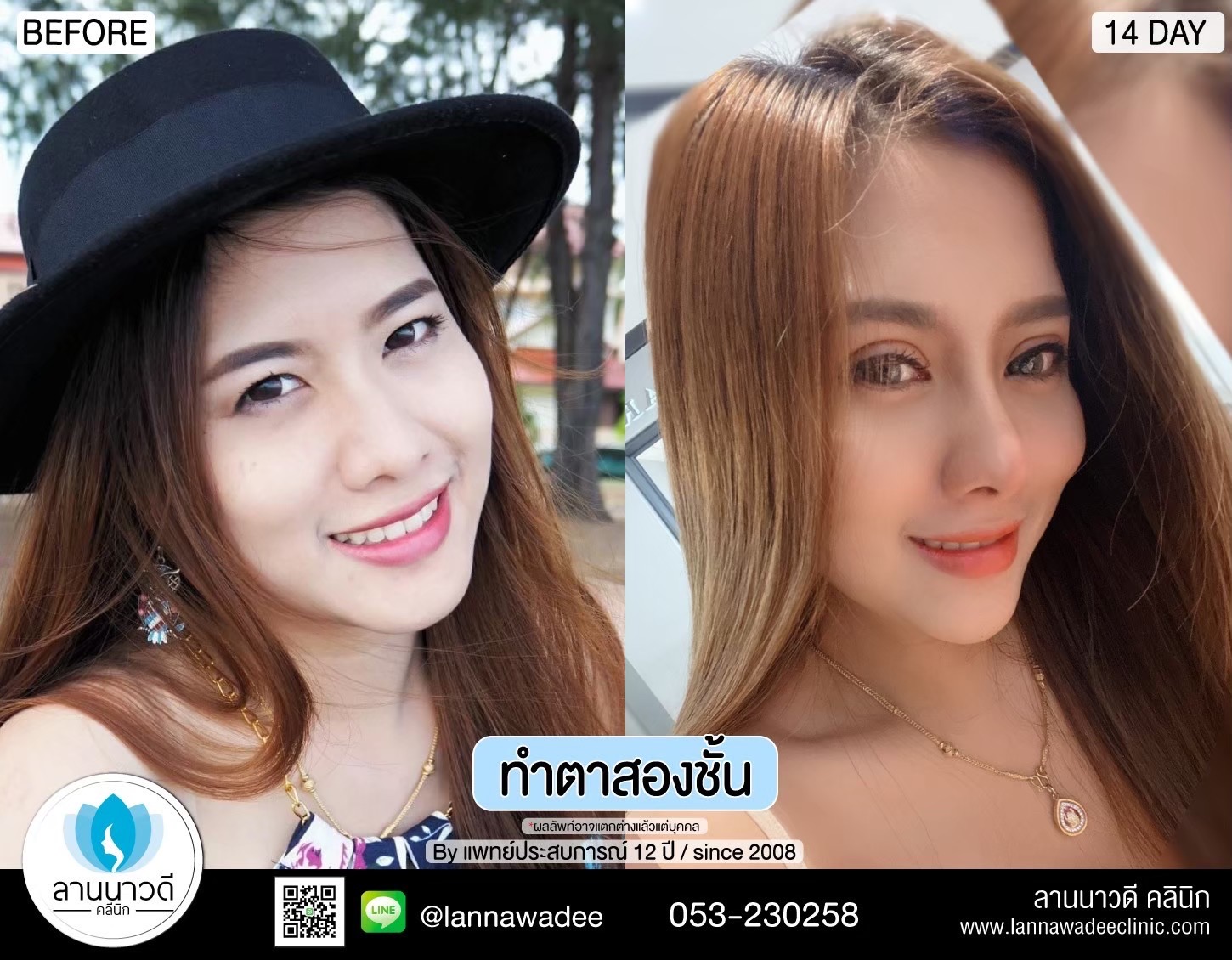 Double Eyelid Surgery Chiang Mai