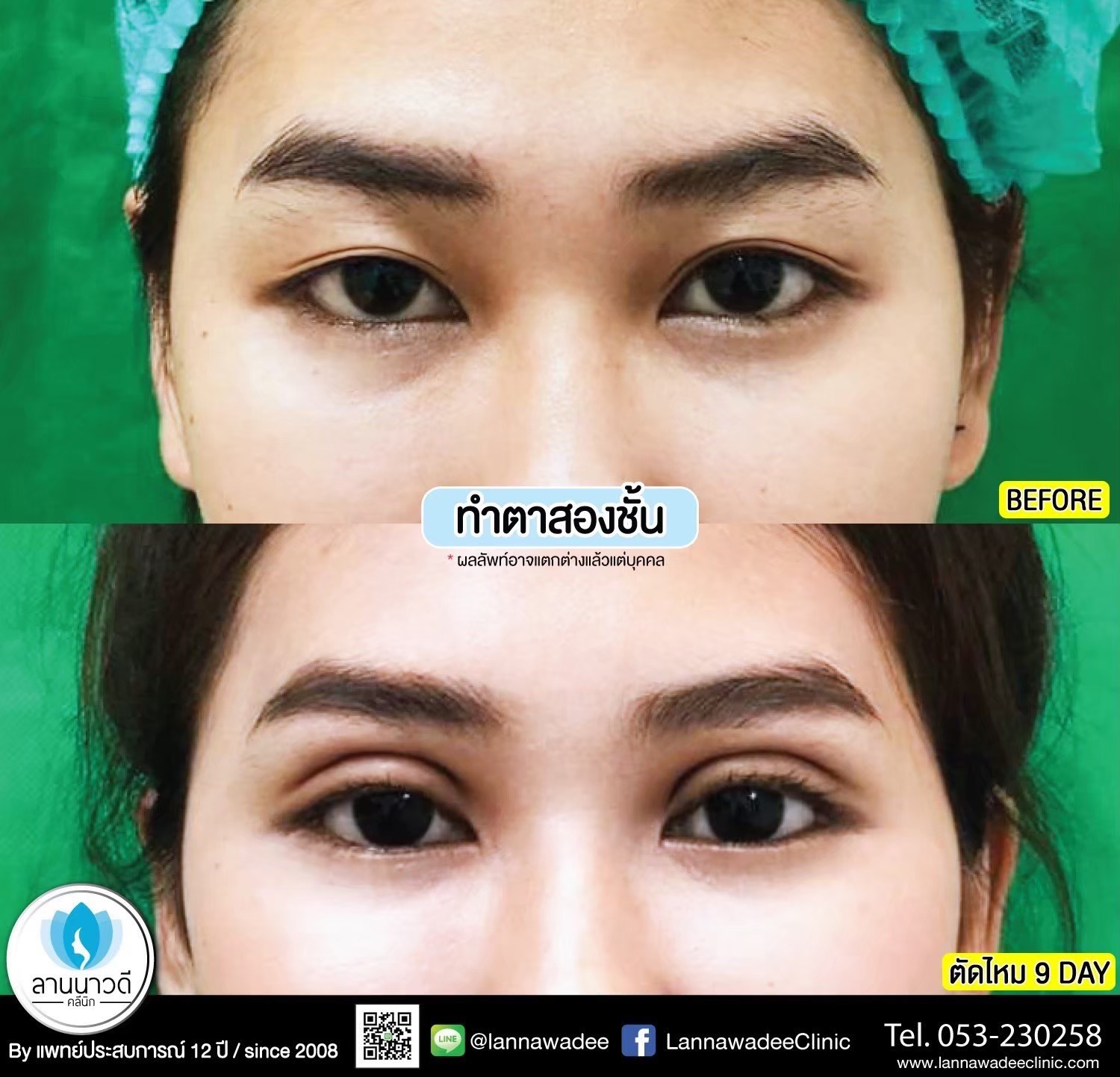 Double Eyelid Surgery Chiang Mai