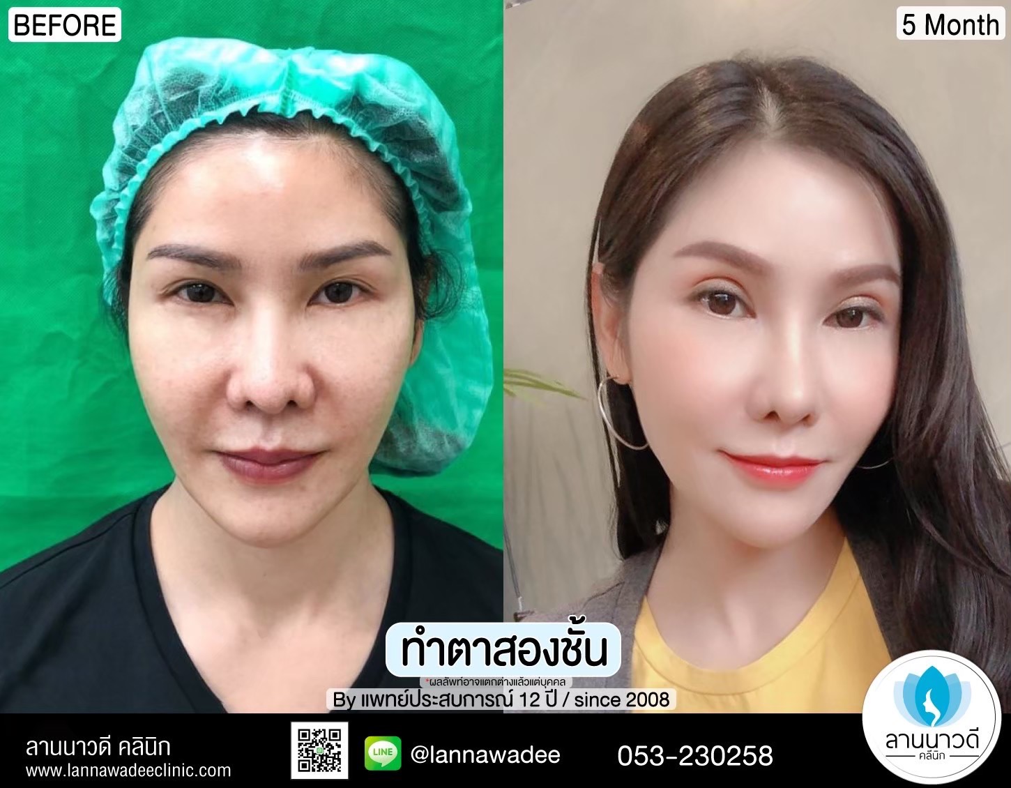 Double Eyelid Surgery Chiang Mai