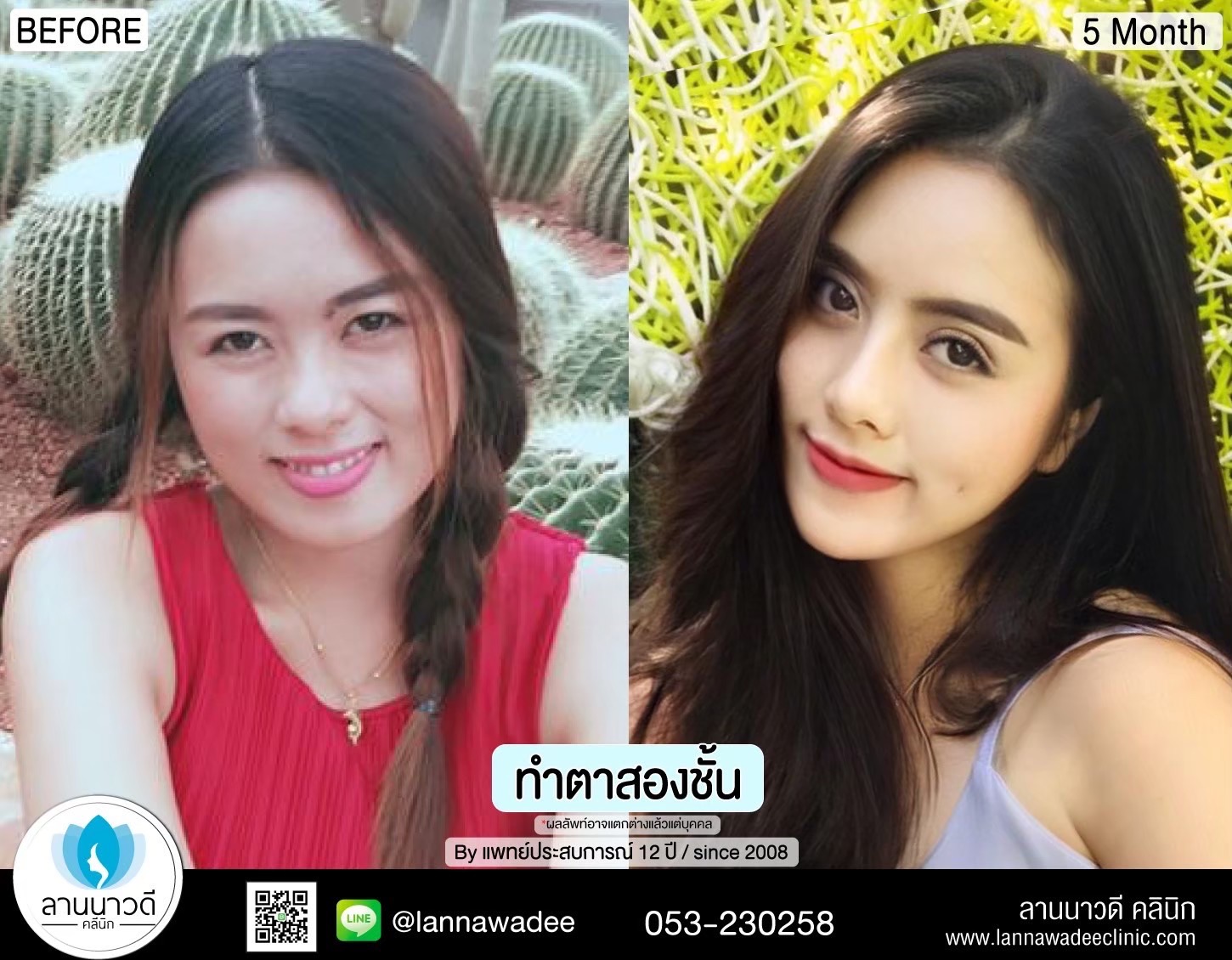 Double Eyelid Surgery Chiang Mai