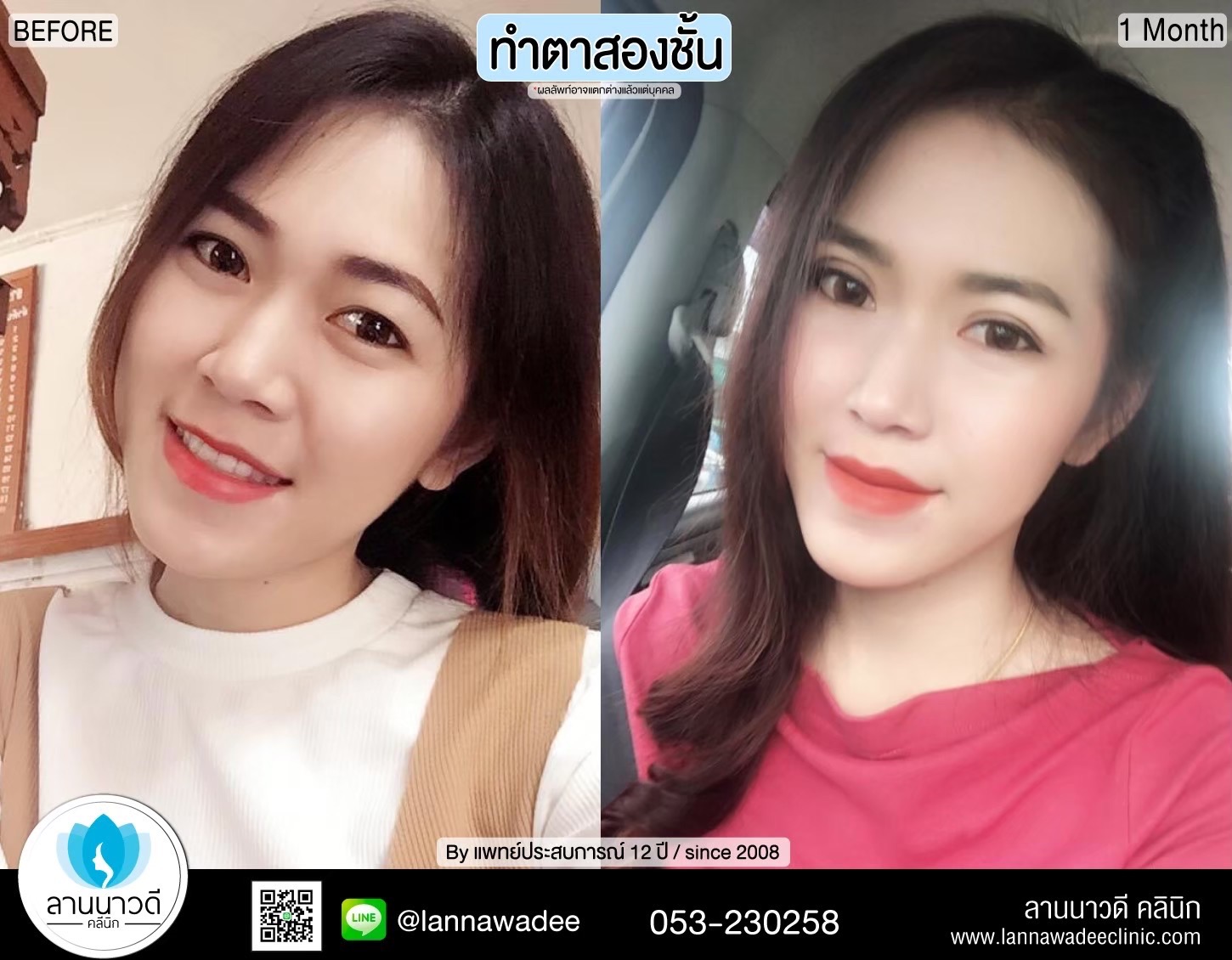 Double Eyelid Surgery Chiang Mai