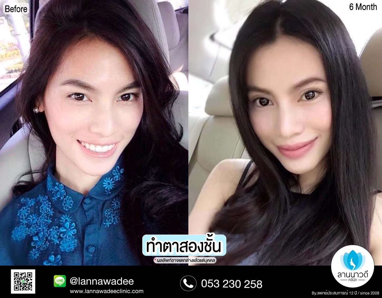 Double Eyelid Surgery Chiang Mai