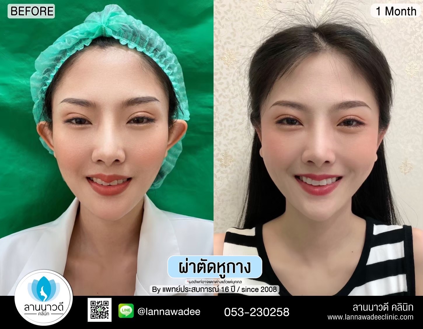 Otoplasty ChiangMai