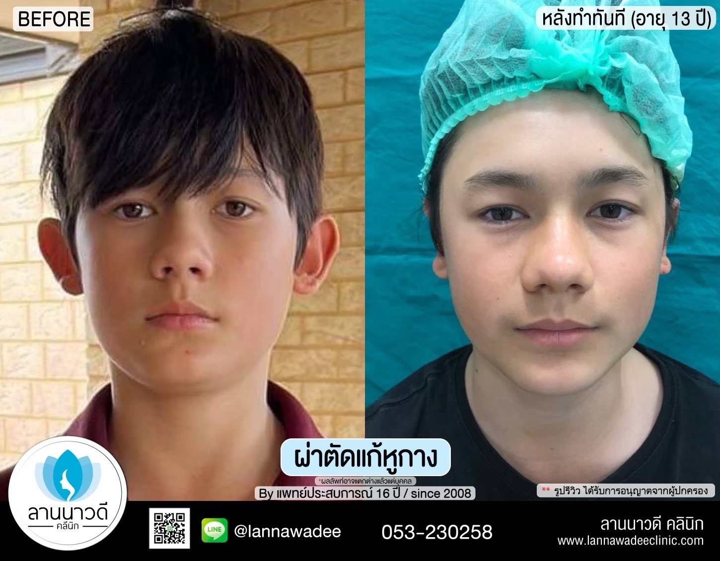 Otoplasty ChiangMai