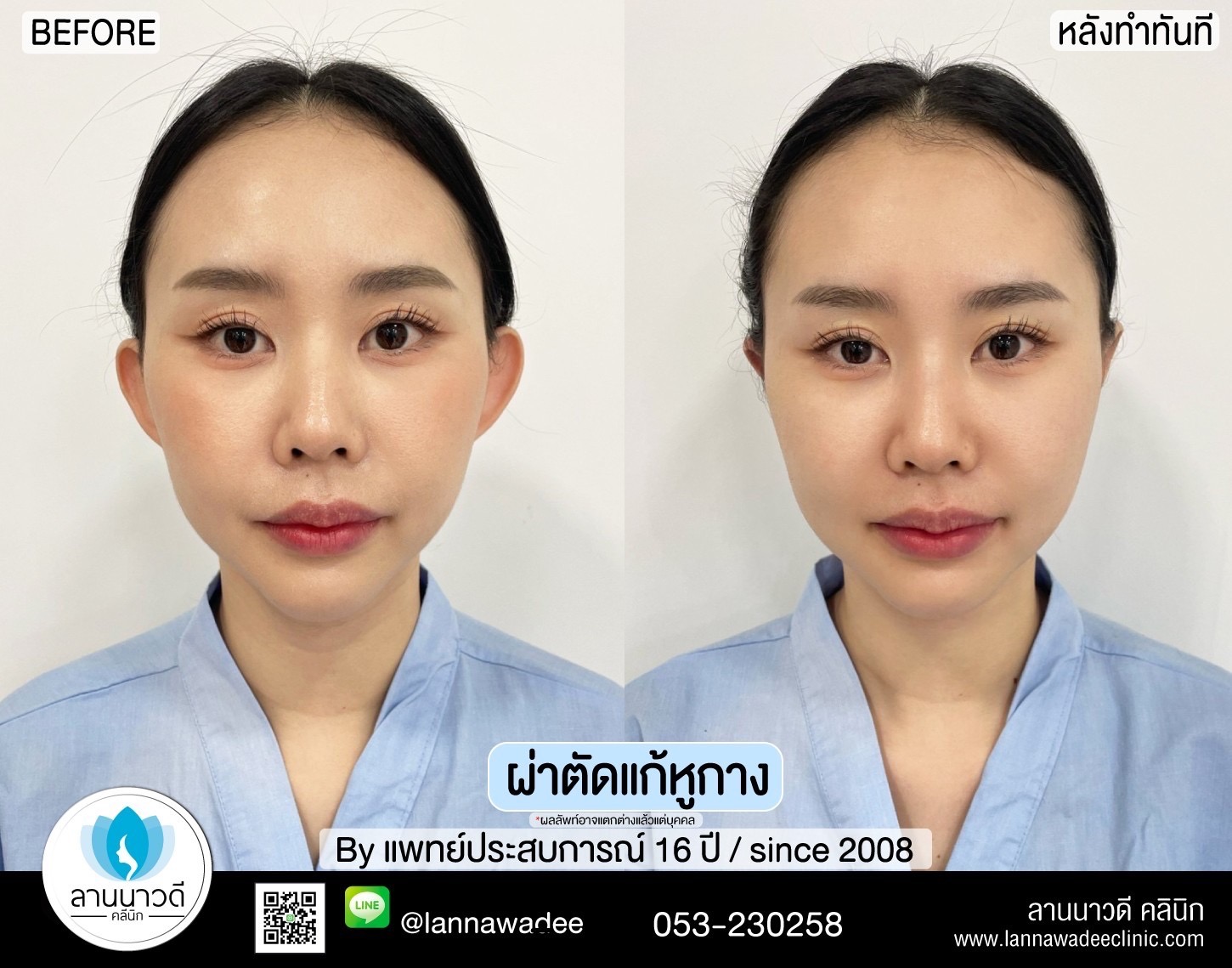 Otoplasty ChiangMai 