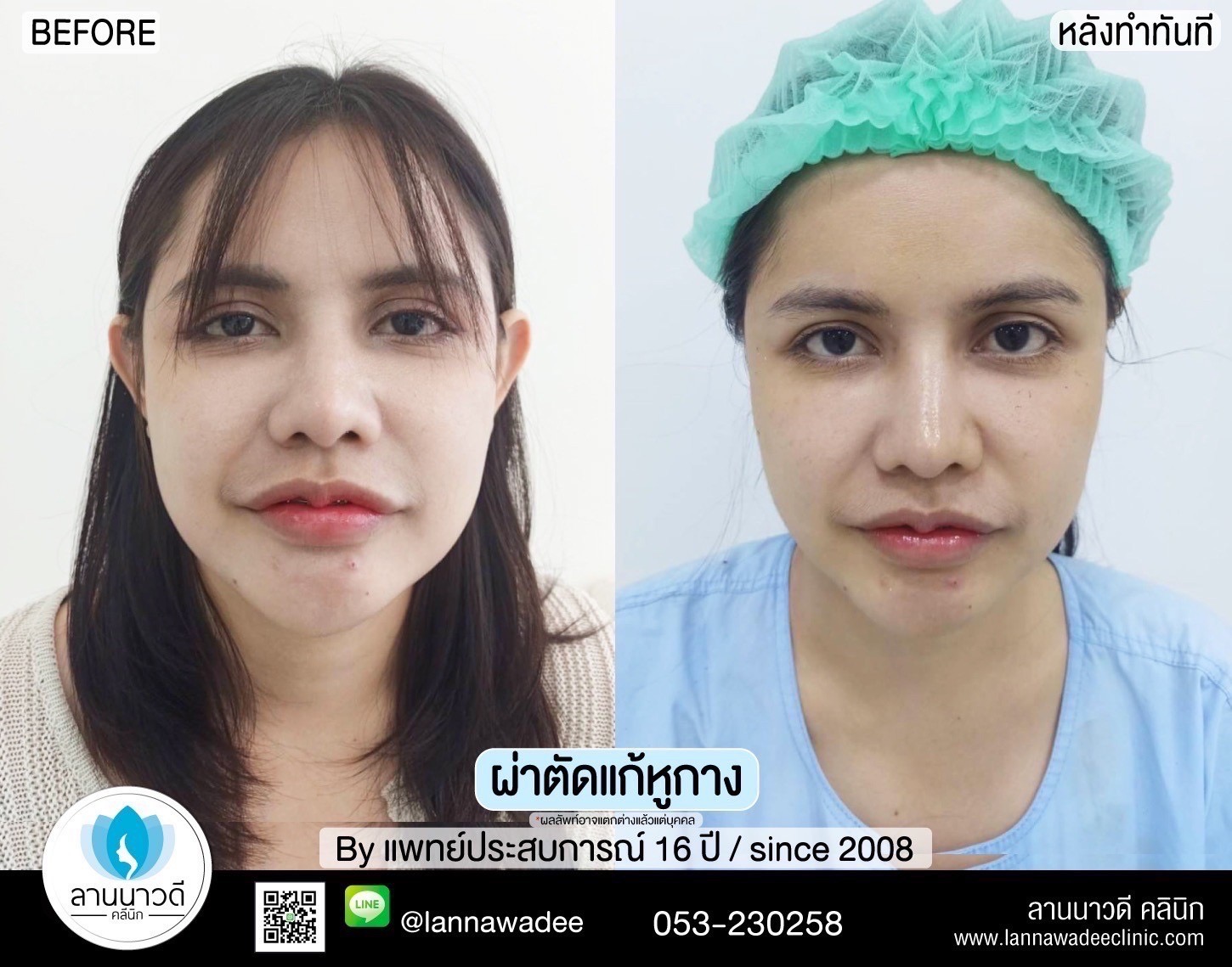 Otoplasty ChiangMai 