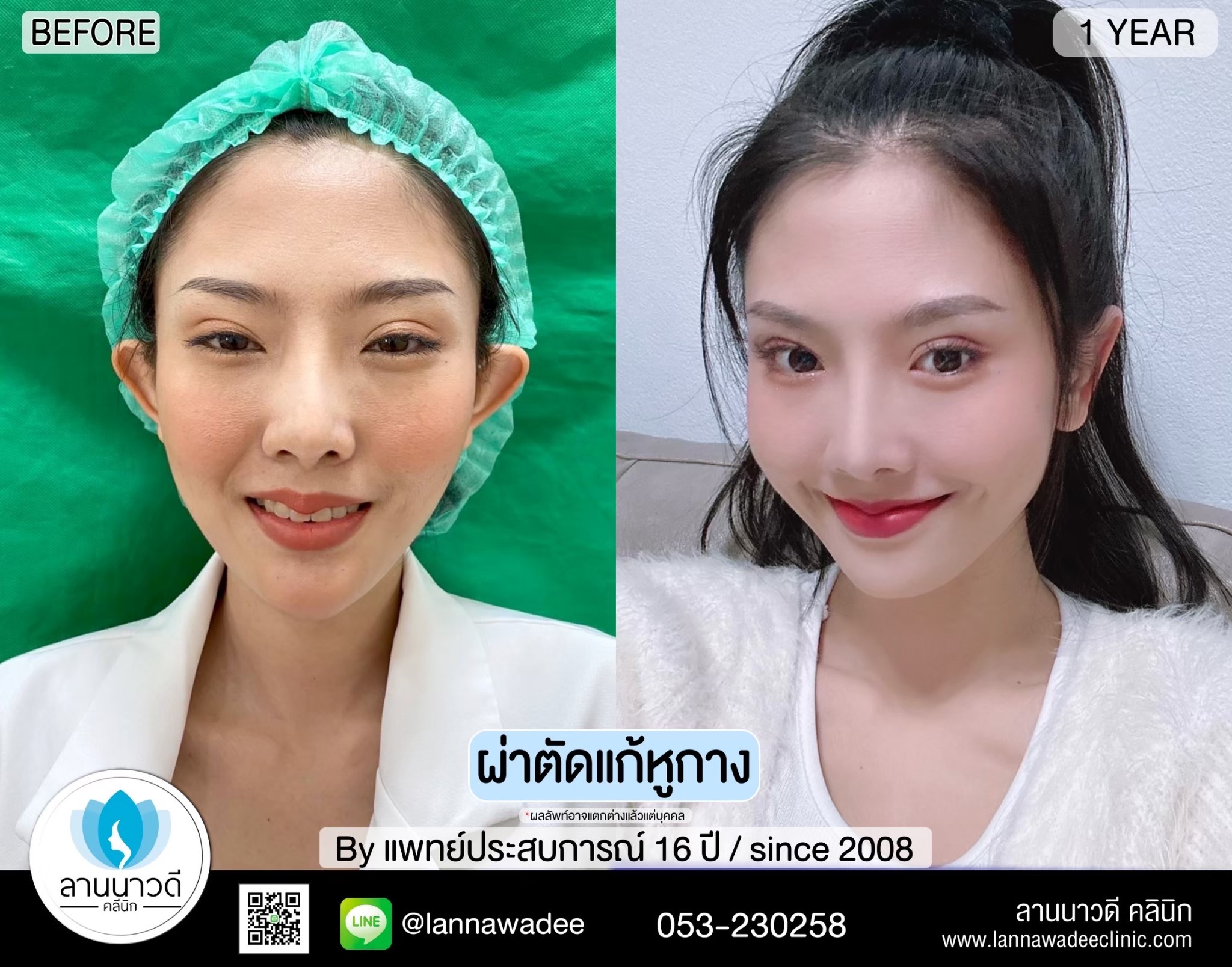 Otoplasty ChiangMai 