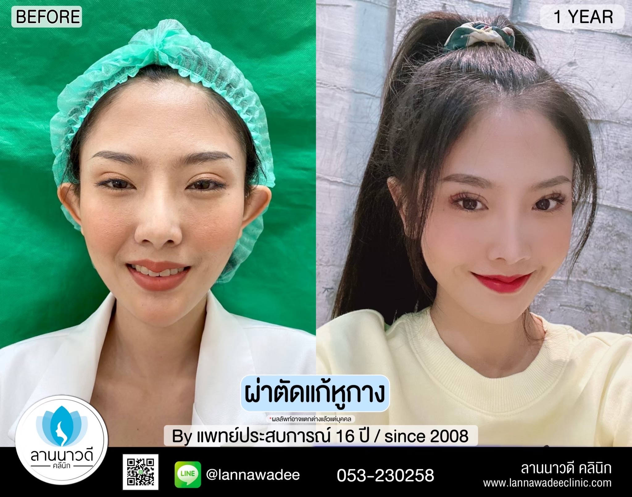 Otoplasty ChiangMai 