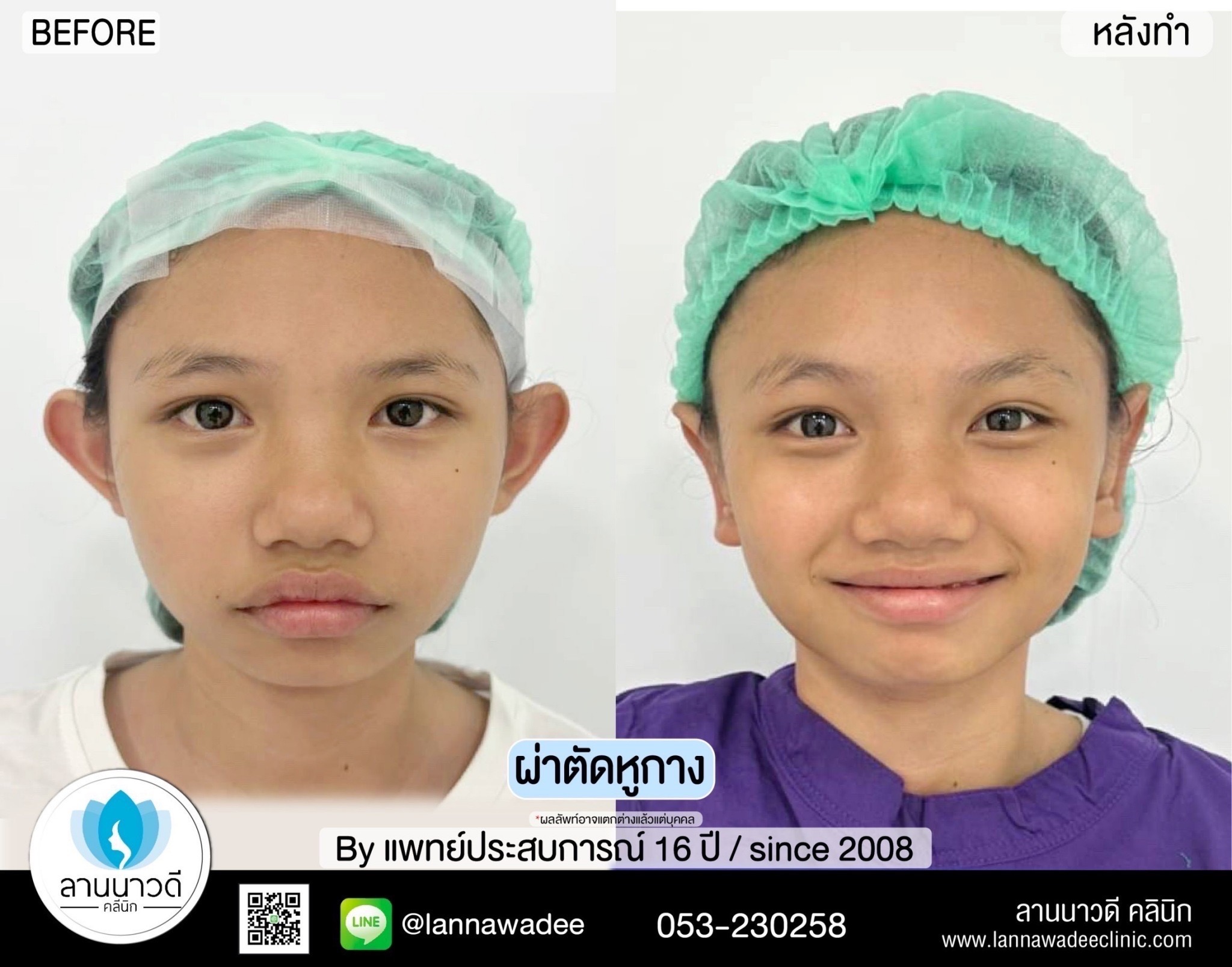 Otoplasty