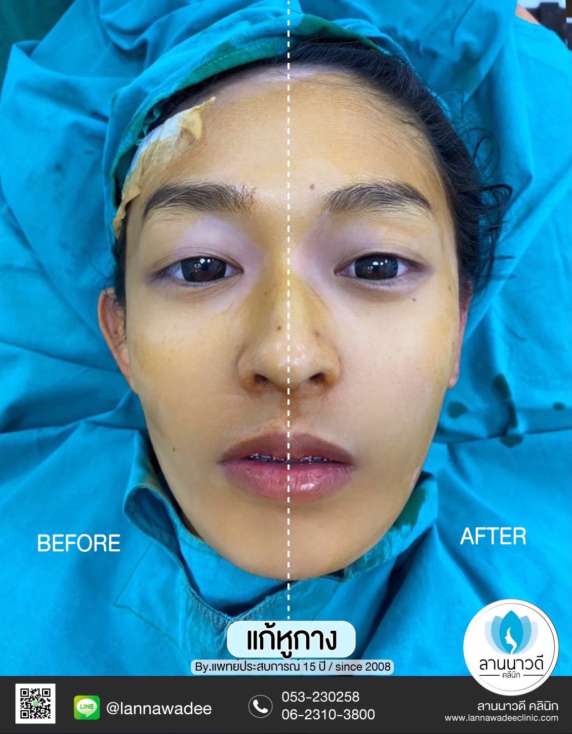 Otoplasty