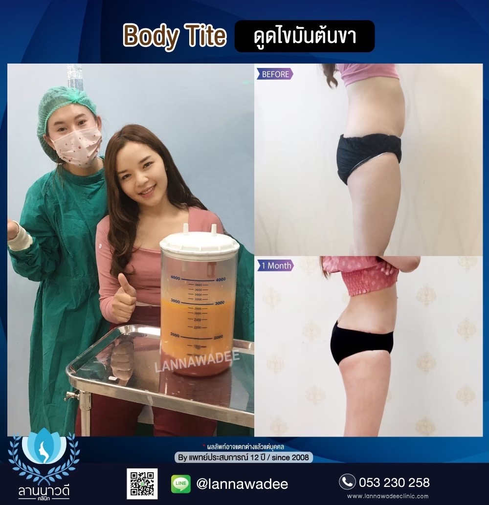 Liposuction Chiang Mai