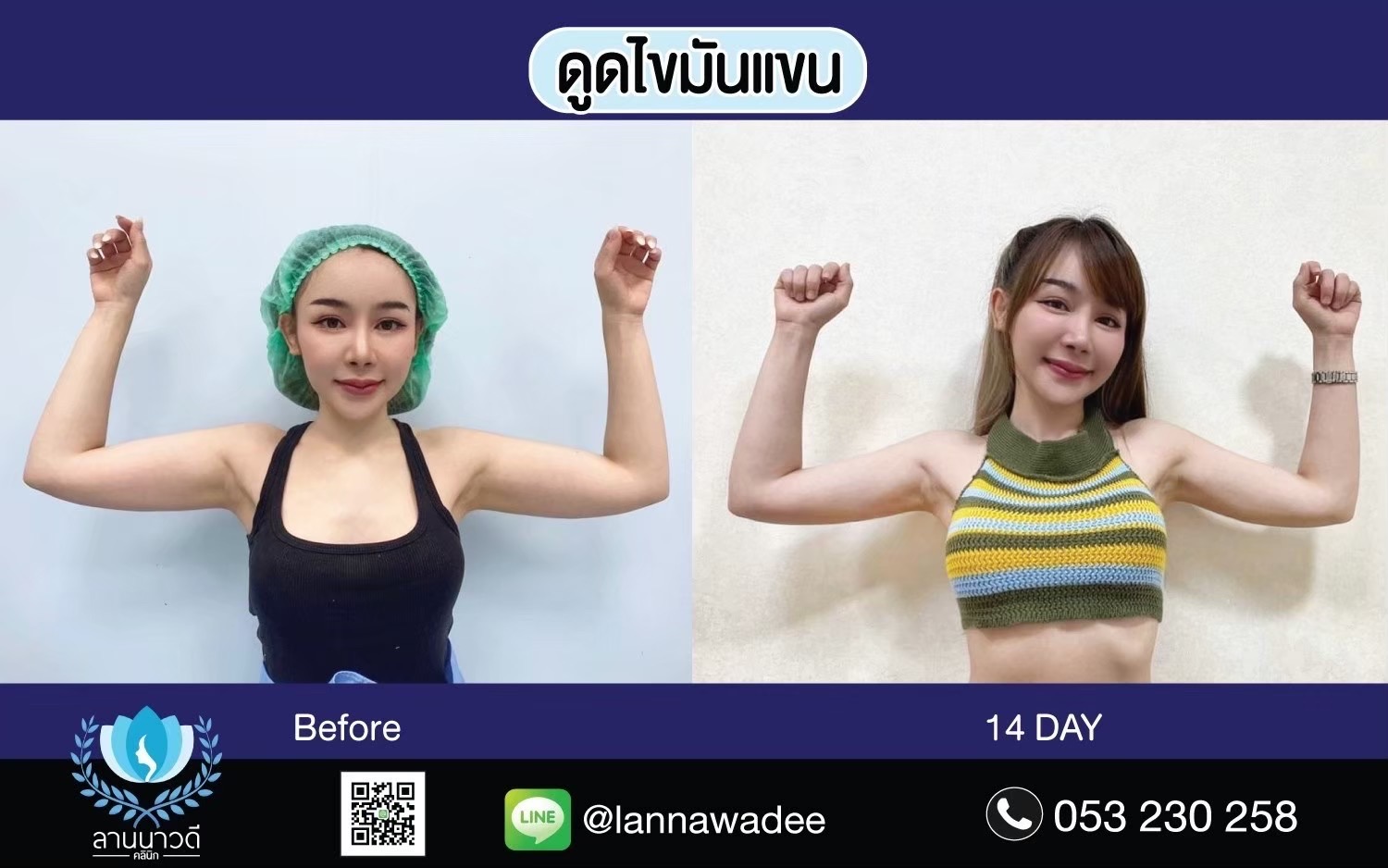 Arm liposuction Chiang Mai