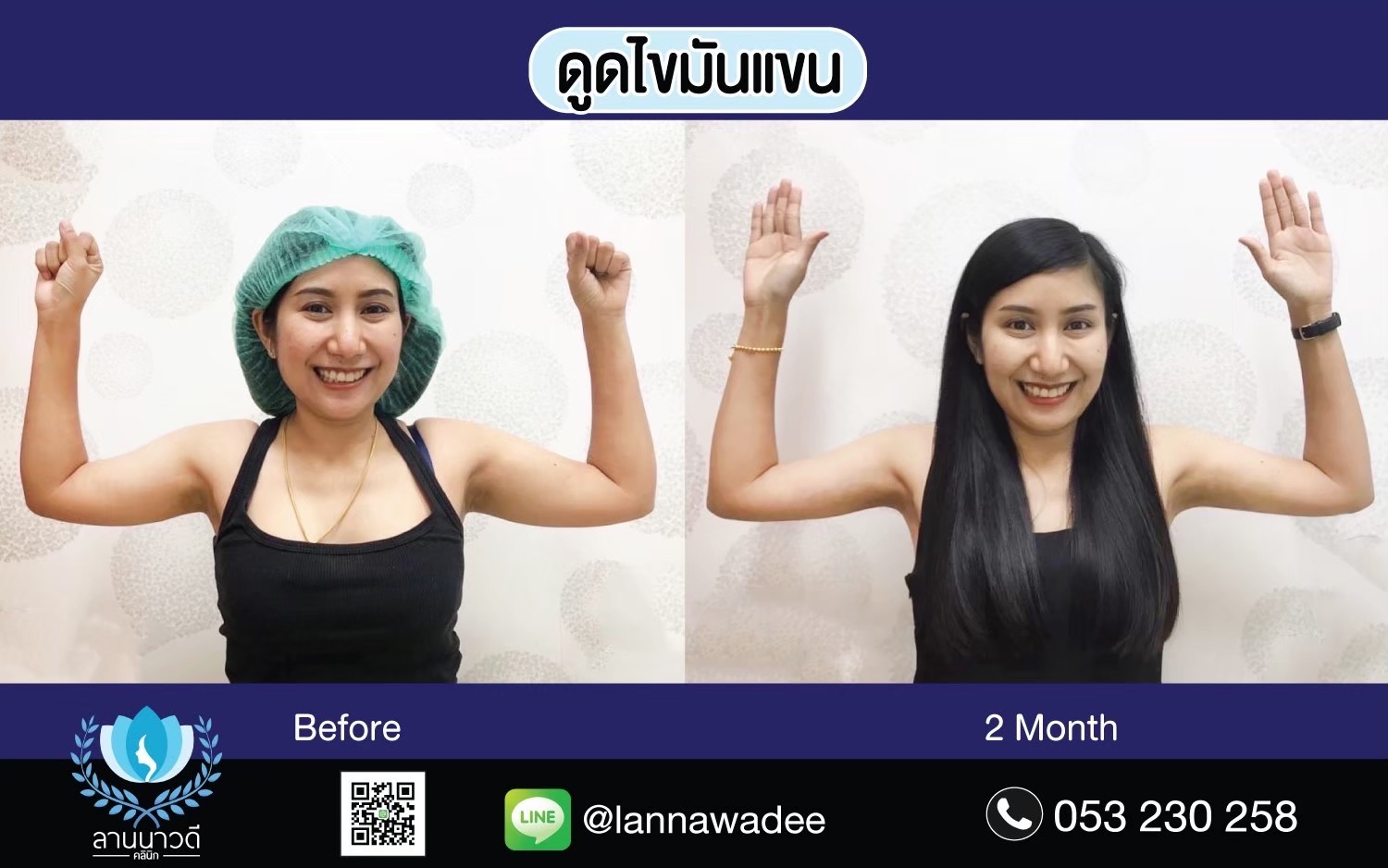 Arm liposuction Chiang Mai