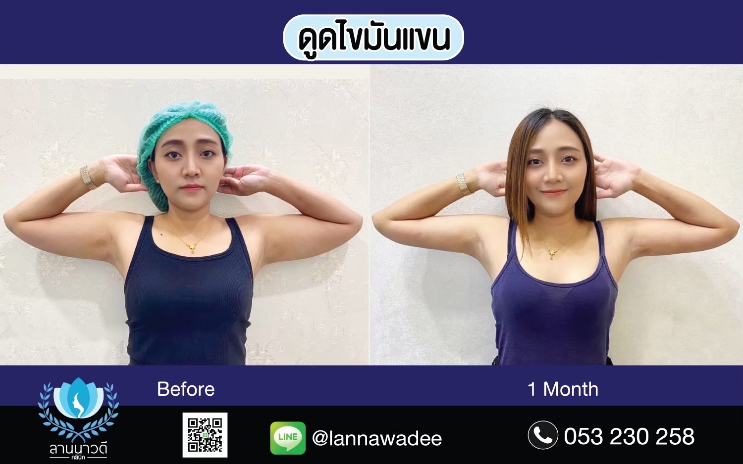 Arm liposuction Chiang Mai