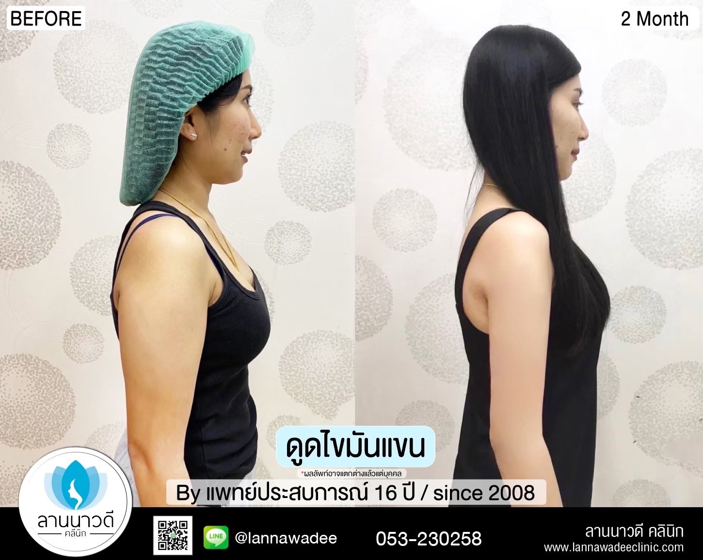 Arm liposuction Chiang Mai