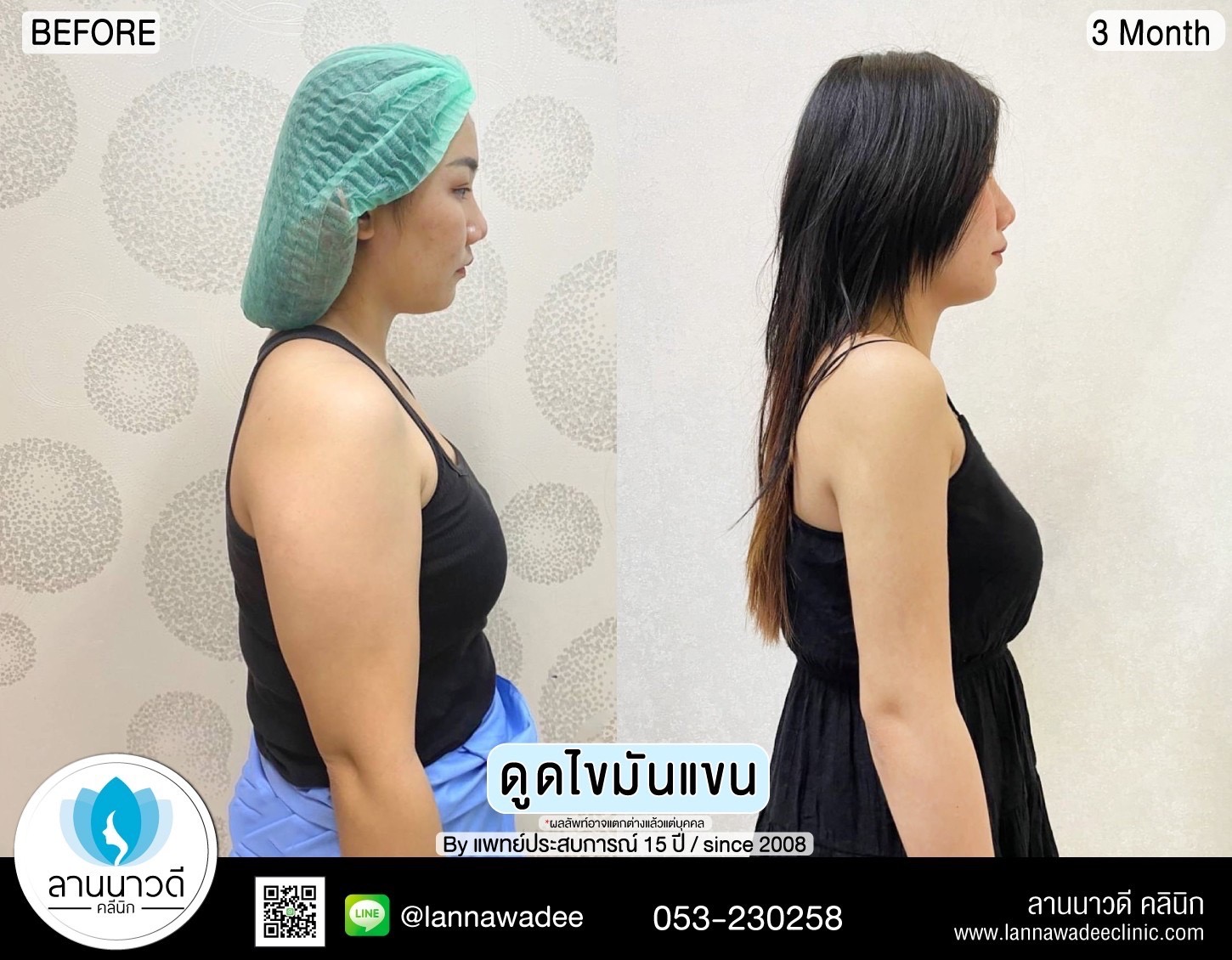 Arm liposuction Chiang Mai