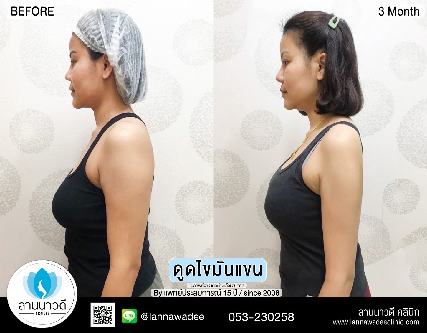 Arm liposuction Chiang Mai