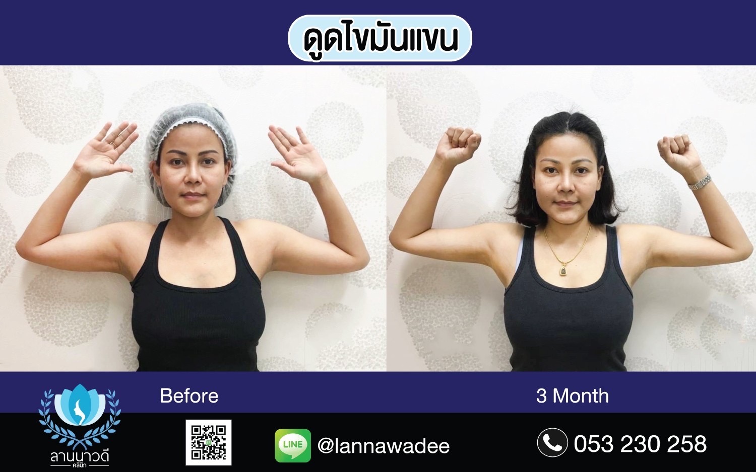 Arm liposuction Chiang Mai