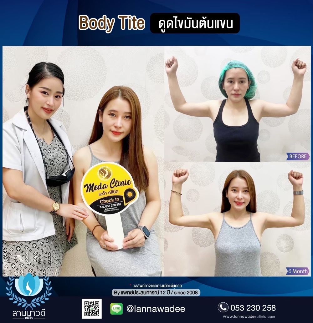 Arm liposuction Chiang Mai