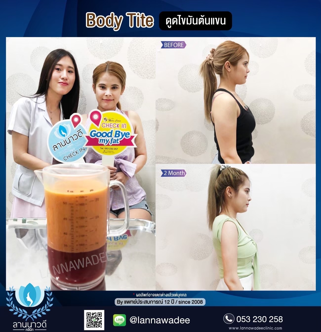 Arm liposuction Chiang Mai