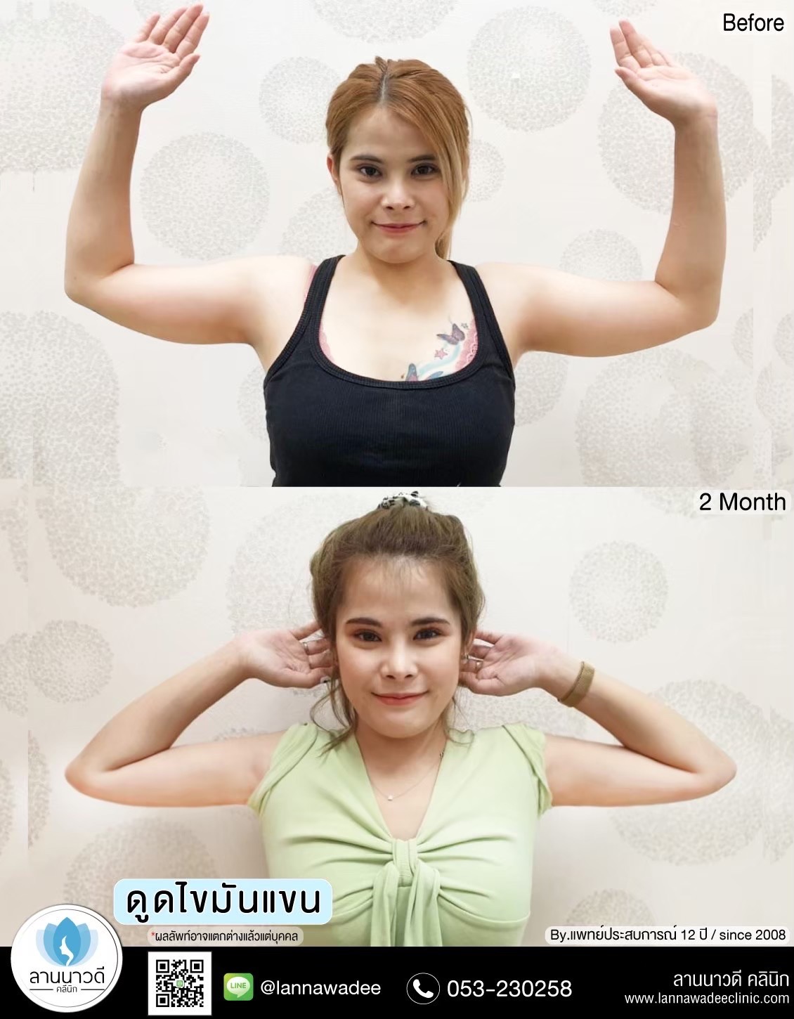 Arm liposuction Chiang Mai