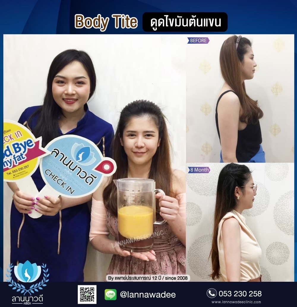 Arm liposuction Chiang Mai