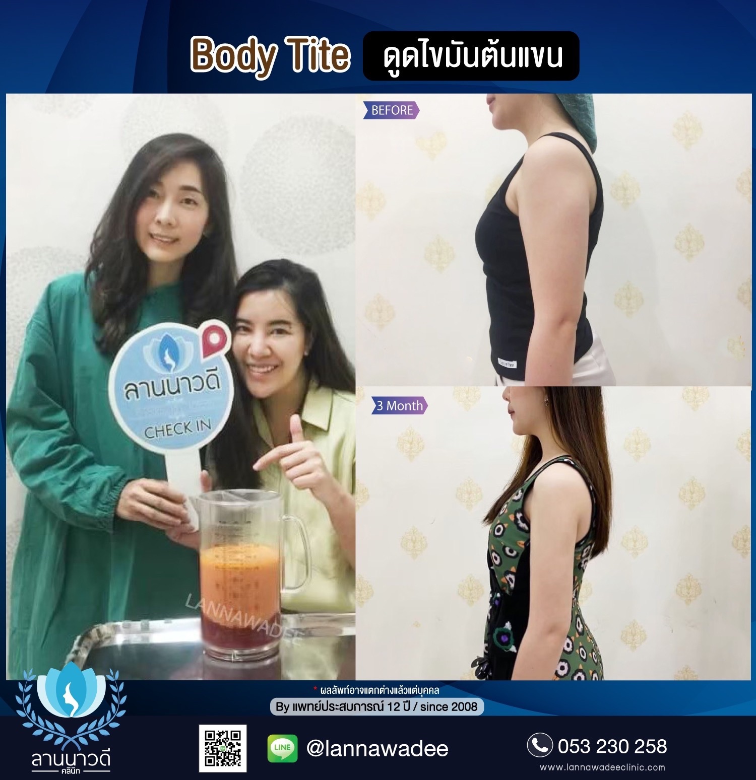 Arm liposuction Chiang Mai