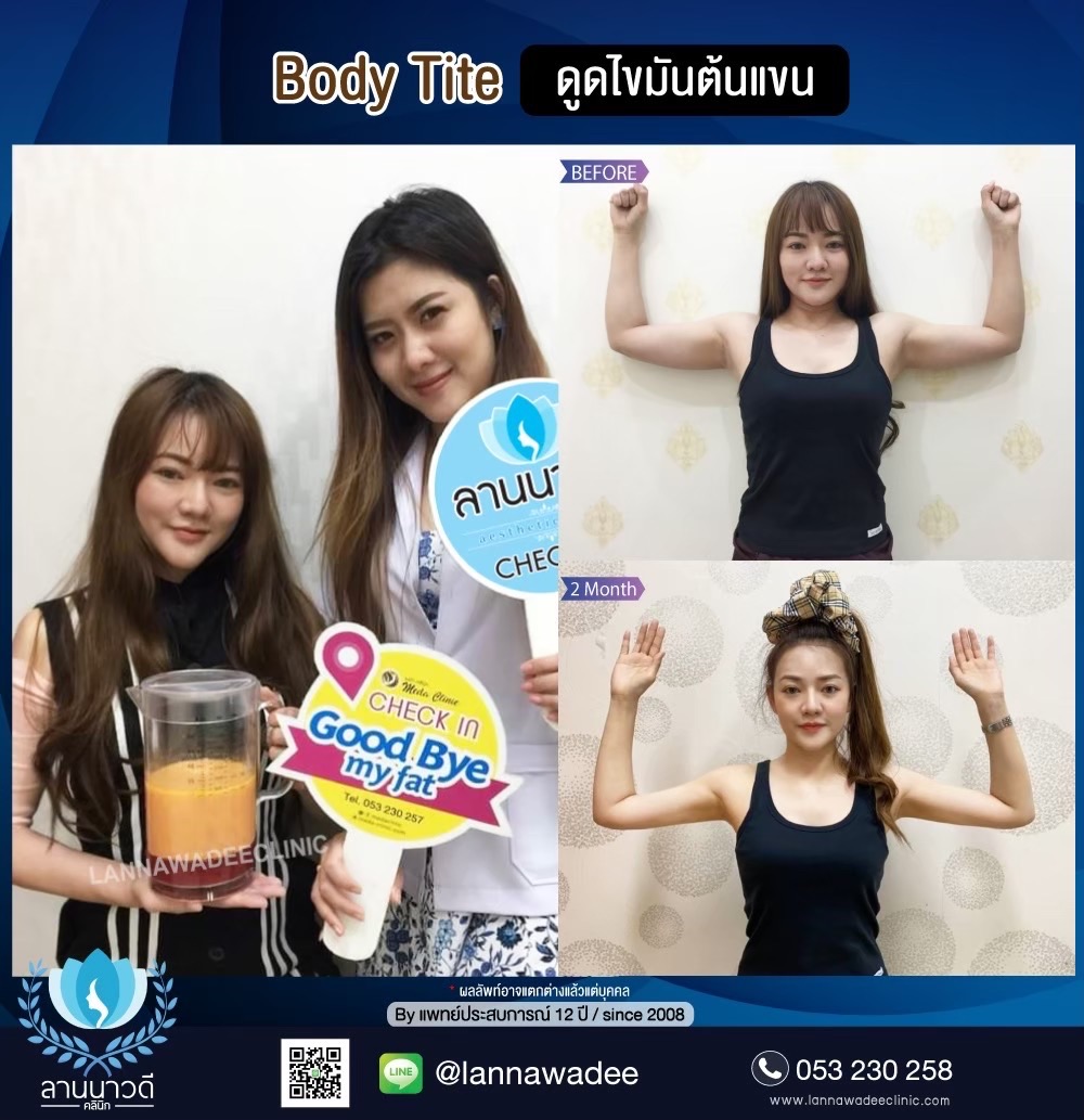 Arm liposuction Chiang Mai