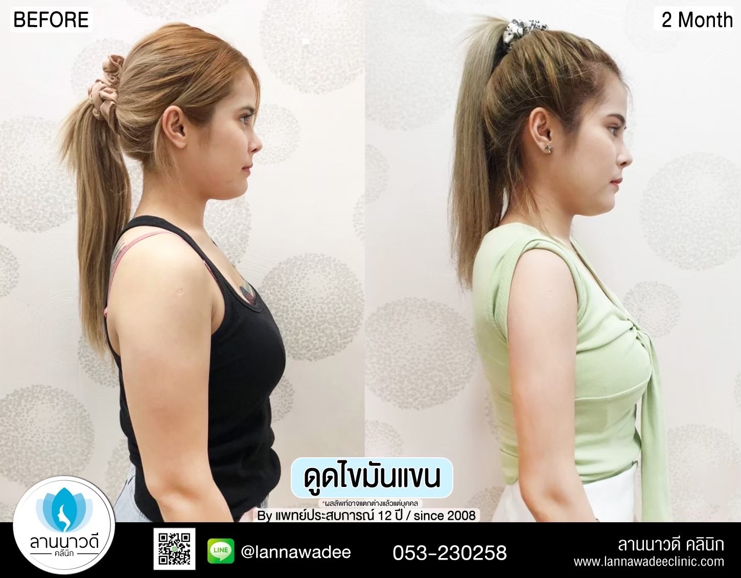 Arm liposuction Chiang Mai