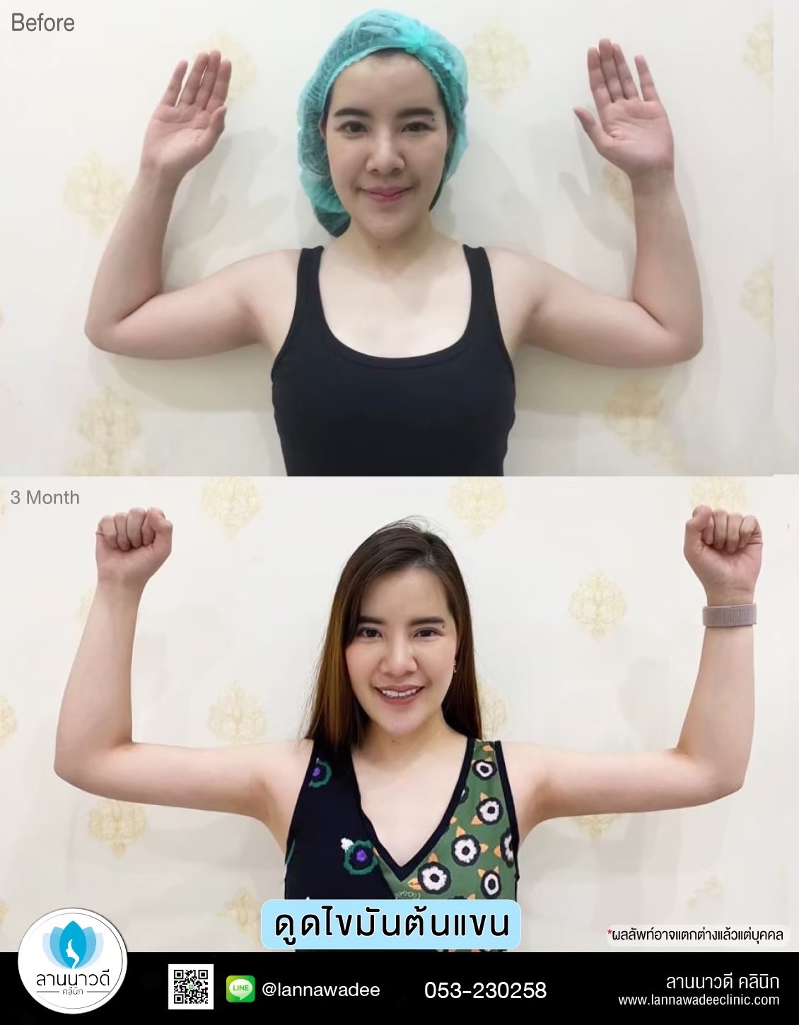 Arm liposuction Chiang Mai