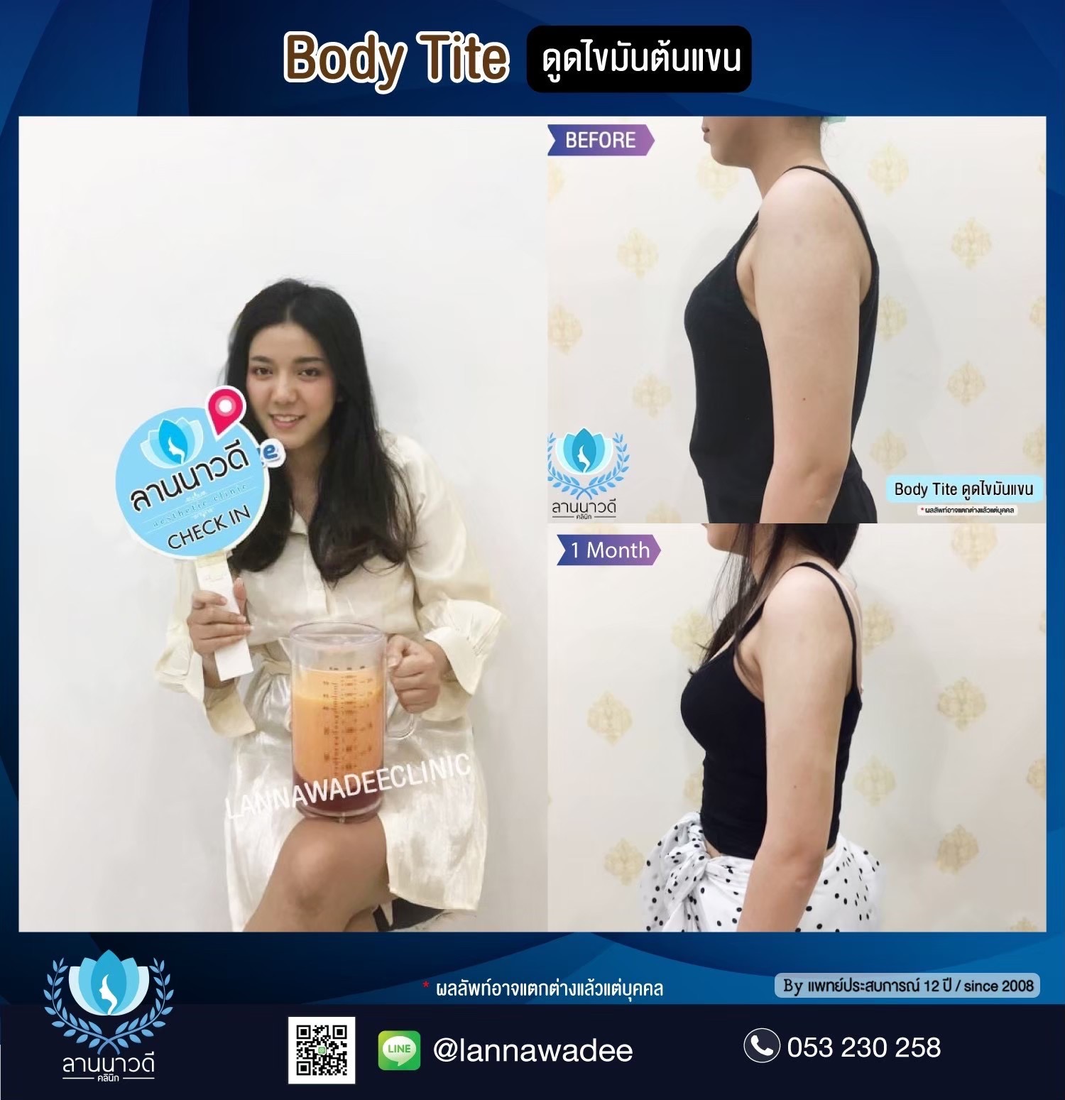 Arm liposuction Chiang Mai