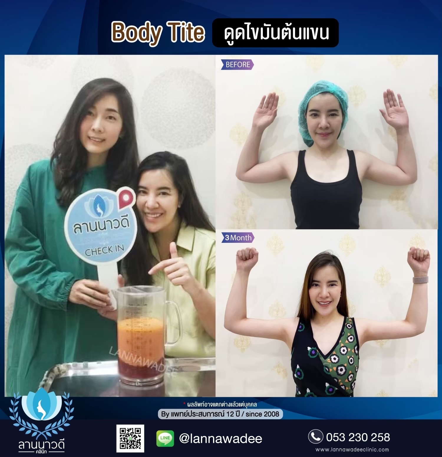 Arm liposuction Chiang Mai