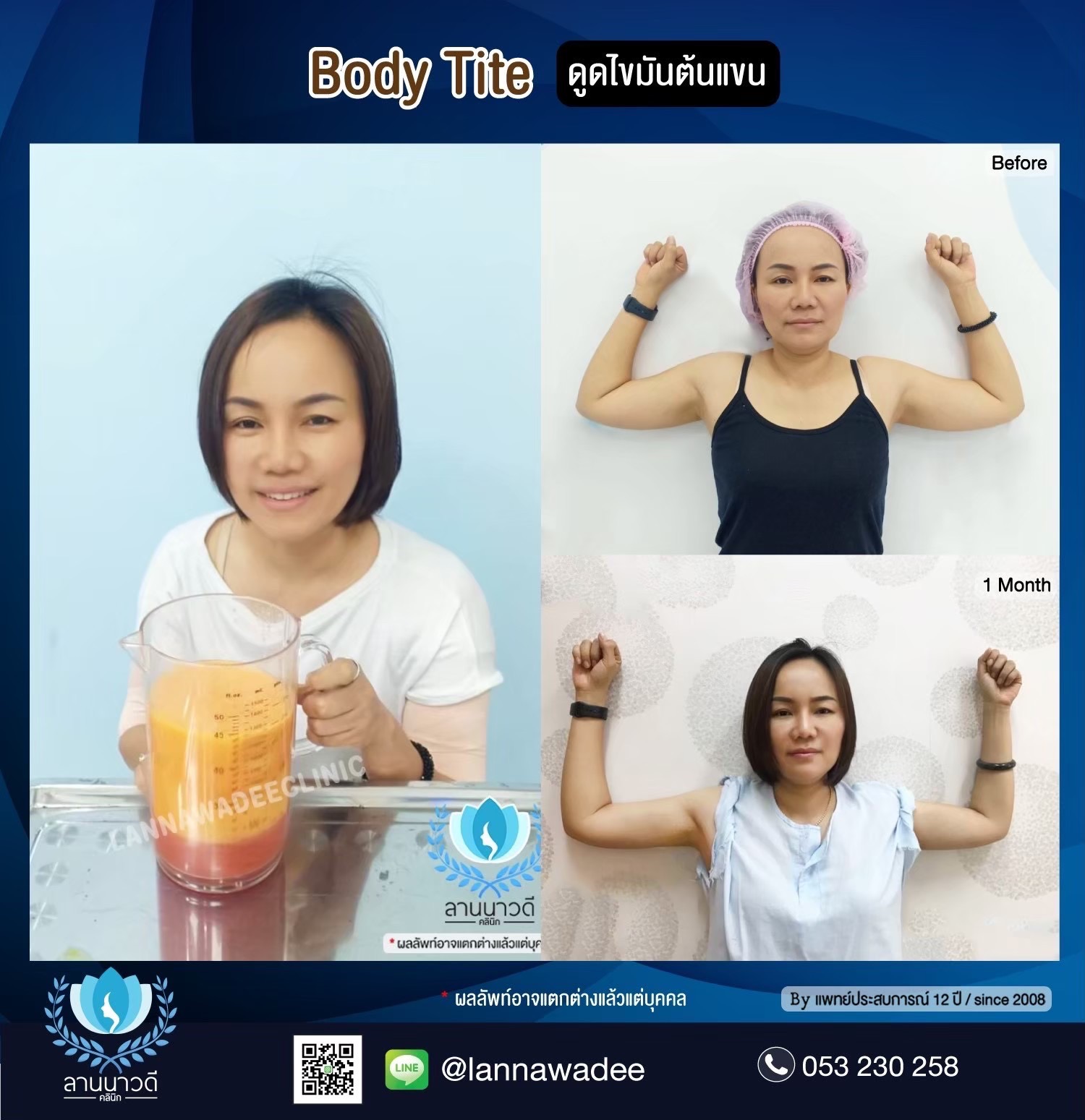 Arm liposuction Chiang Mai